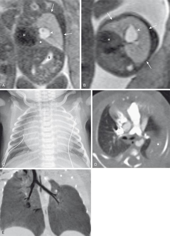 e-Figure 53.3, Bronchial atresia.