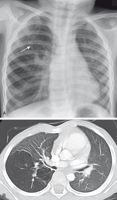 e-Figure 53.4, Bronchial atresia in an older child.