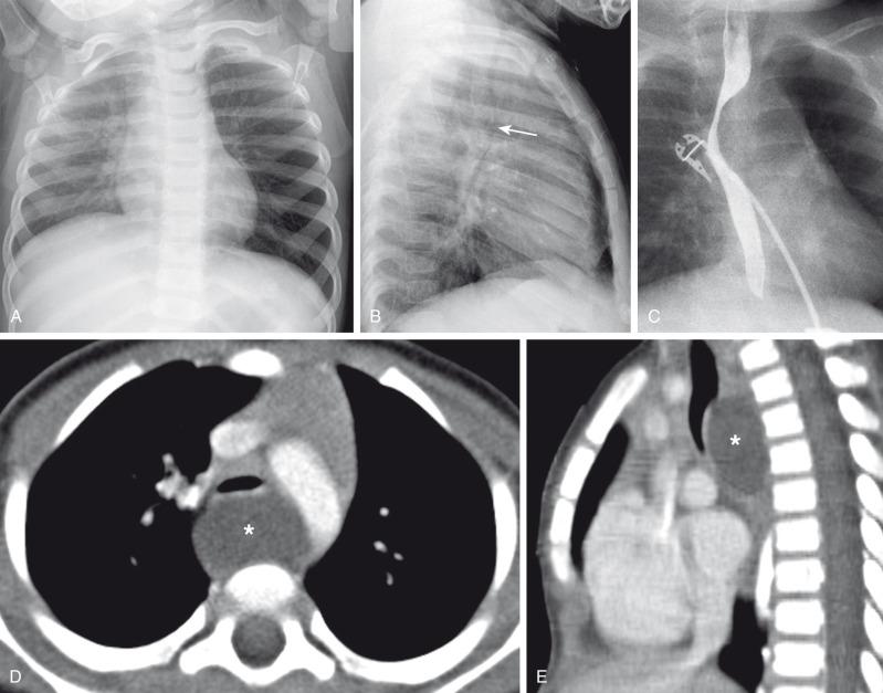 Figure 53.6, Bronchogenic cyst in a 15-month-old child with stridor.