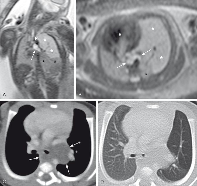 e-Figure 53.5, Bronchogenic cyst.