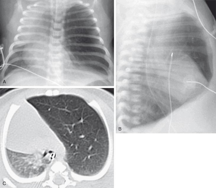 Figure 53.7, Congenital lobar overinflation in a 3-day-old with increasing tachypnea.