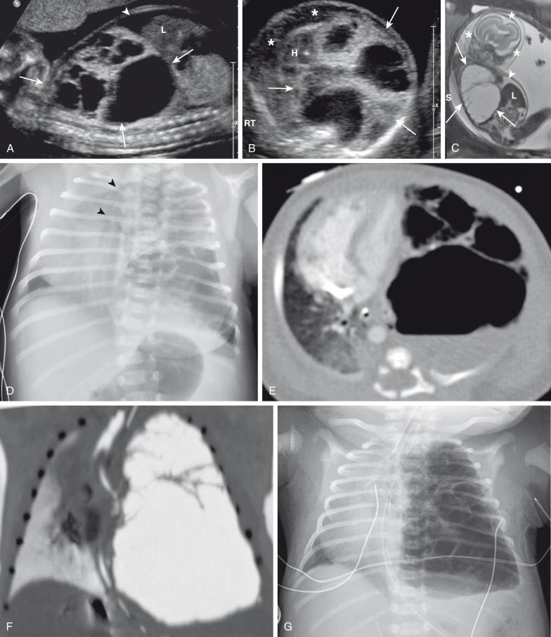 Figure 53.8, Congenital pulmonary airway malformation type 1.