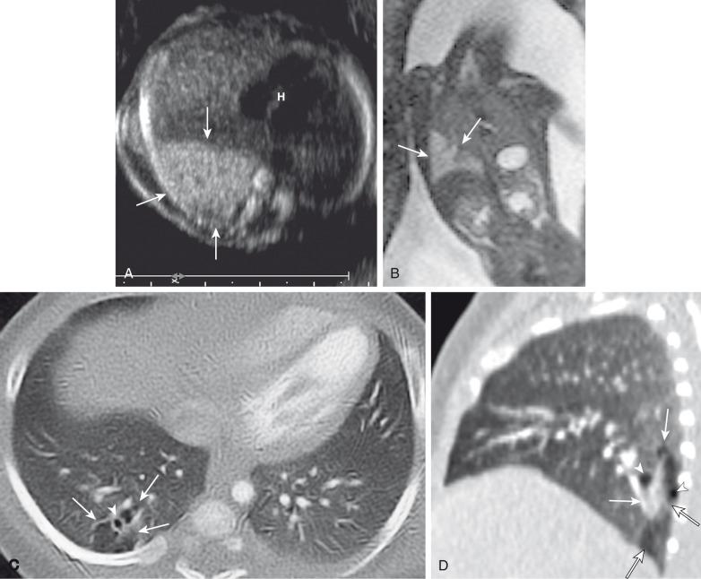 e-Figure 53.9, Congenital pulmonary airway malformation (CPAM) type 2.