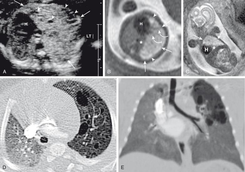 e-Figure 53.10, Congenital pulmonary airway malformation type 2.