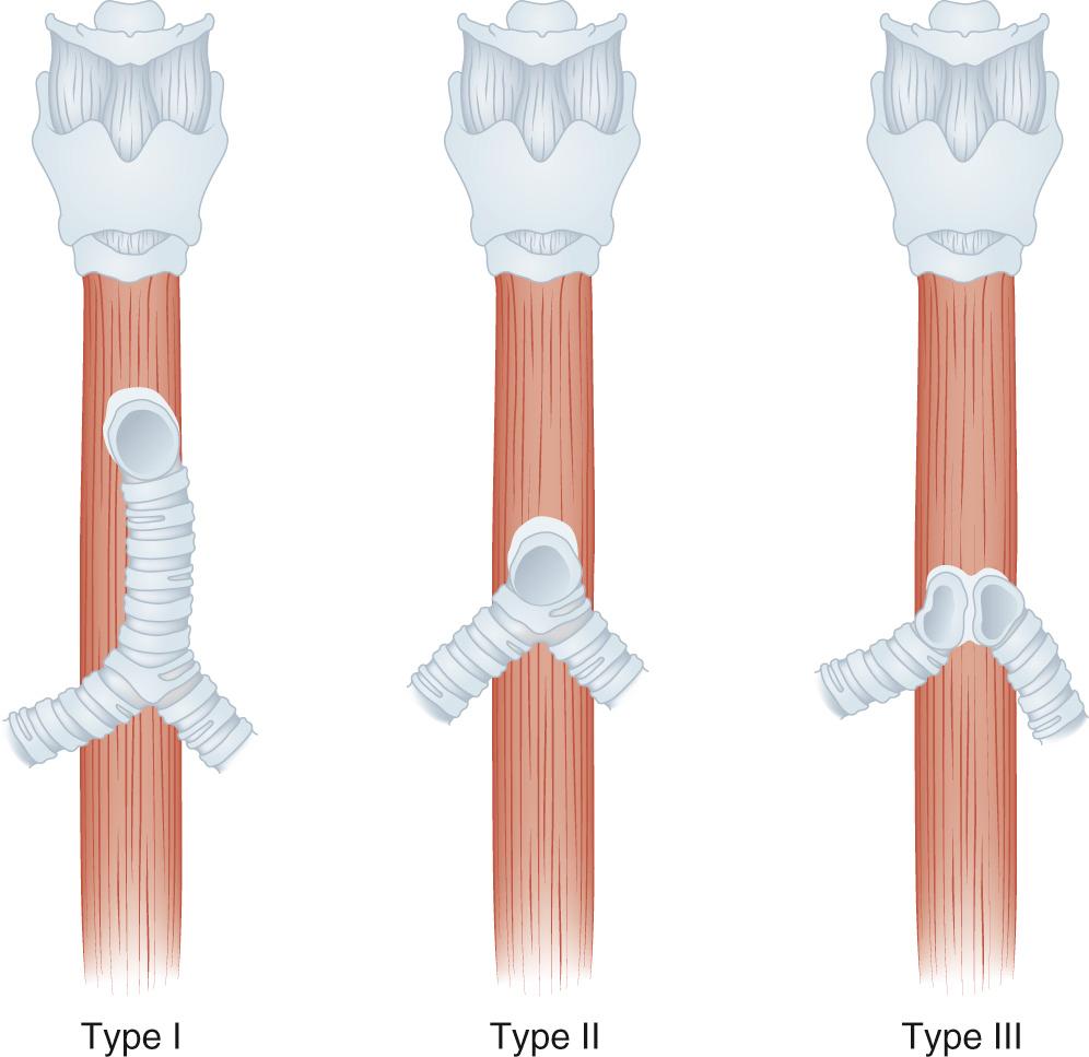 FIGURE 9-1, Tracheal agenesis classification. There are three types of tracheal agenesis: type I, the trachea originates from the esophagus rather than from the larynx; type II, no trachea is present and the carina originates from the esophagus; and type III, each mainstem bronchus originates from the esophagus.