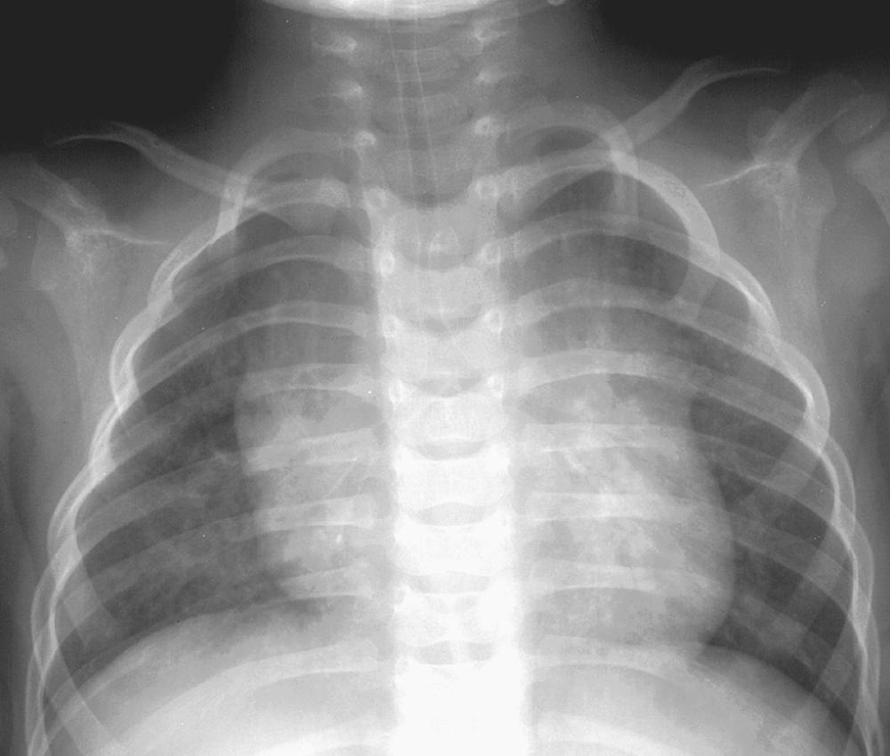 FIGURE 9-2, Tracheal stenosis (stovepipe trachea) in a 20-month-old boy with stridor since birth. Frontal chest radiograph shows a diffusely narrowed trachea faintly outlined by water-soluble contrast medium.