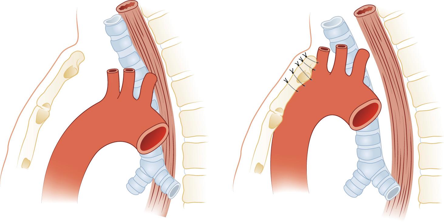 FIGURE 9-4, Tracheomalacia and aortopexy. In patients with severe tracheomalacia and aortopexy, suturing of the proximal transverse-ascending aorta to the anterior chest wall or sternum may significantly improve the obstructive symptoms.