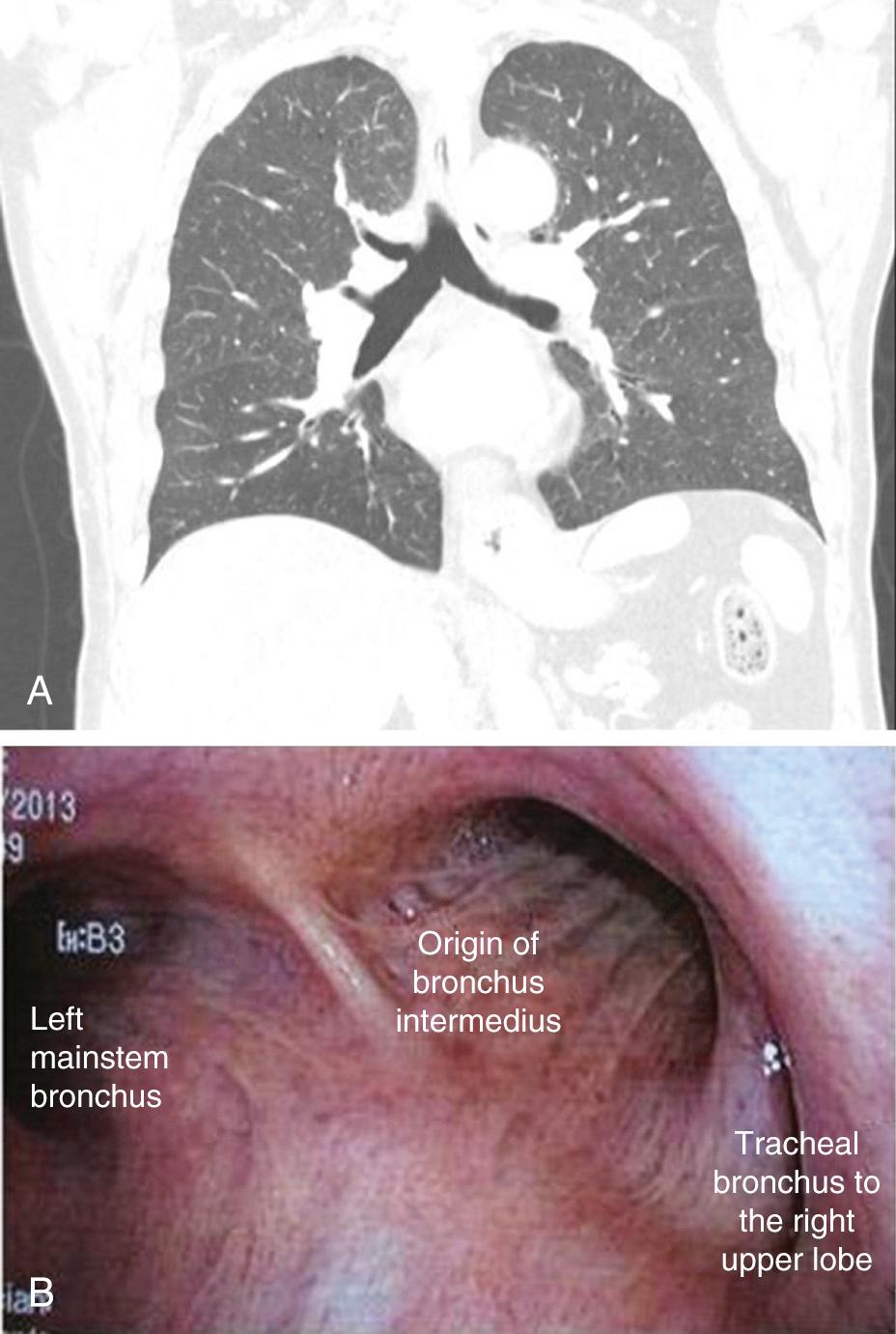 FIGURE 9-5, A, Coronal view of a computed tomography scan showing a tracheal bronchus. B, Bronchoscopic view of the origin of the right upper lobe bronchus from the trachea.
