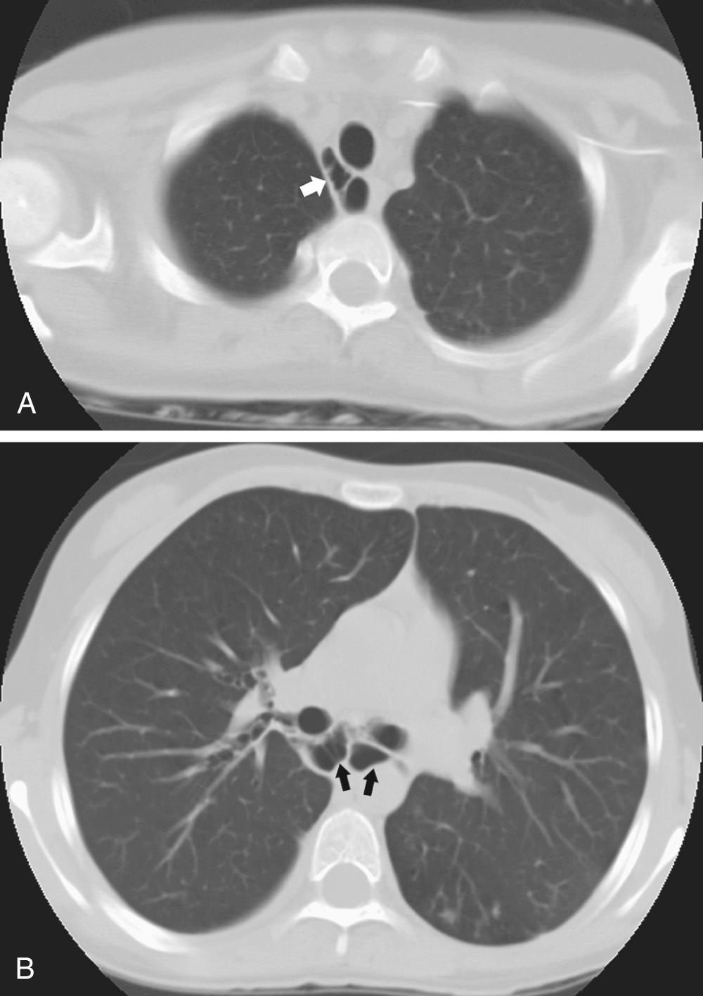FIGURE 9-6, Tracheobronchomegaly (Mounier-Kuhn syndrome) in a 13-year-old girl with chronic cough and bronchiectasis. Computed tomography scan at the level of the trachea (A) and mainstem bronchi (B) shows air-filled saccules (arrows) around the airway from chronic inflammation destroying the normal elastic properties of the tracheobronchial tree and its smooth muscles.