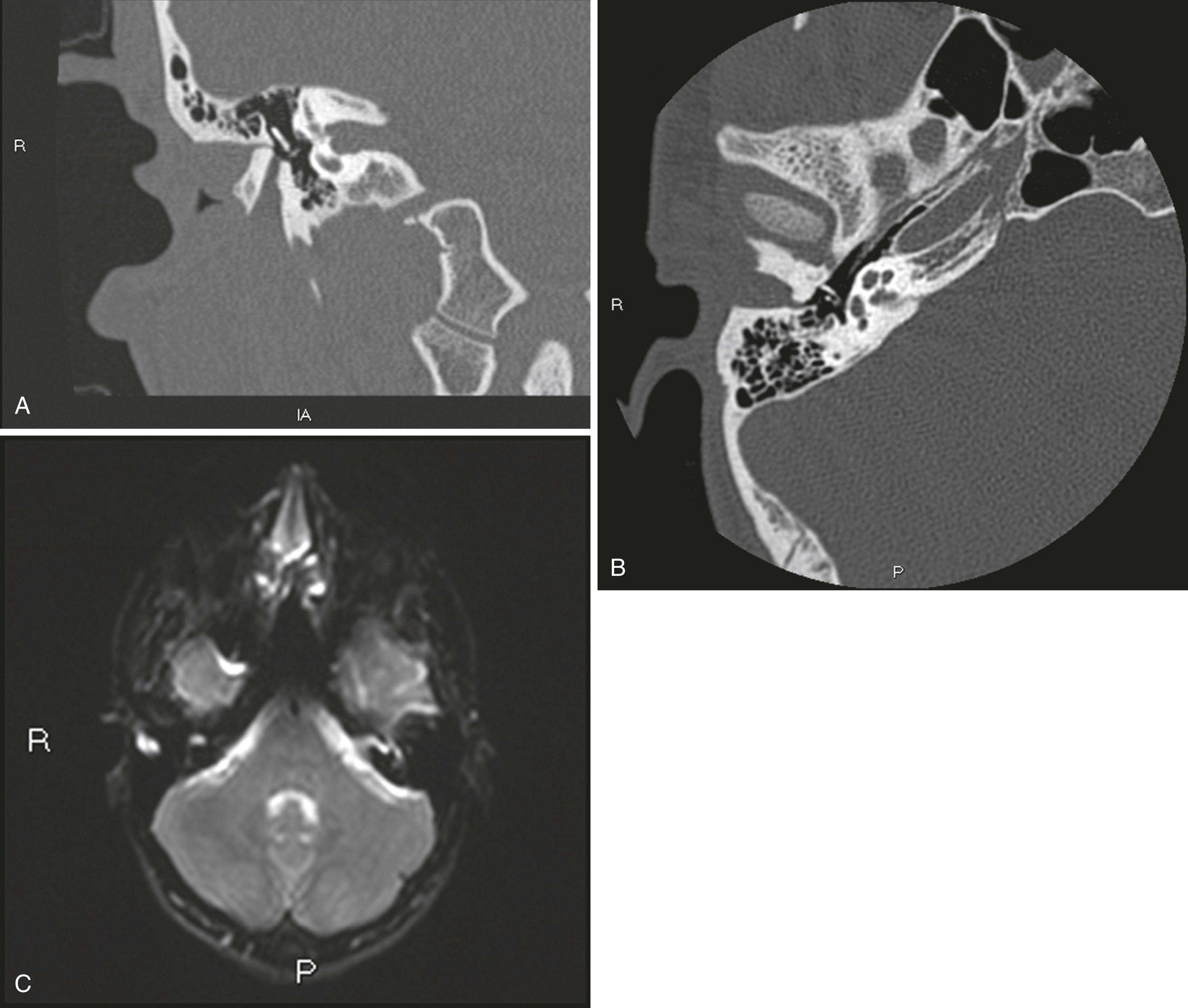 Fig. 4.1, High-resolution computed tomography in the coronal (A) and axial planes (B) of an acquired ear canal cholesteatoma in the right ear. Note the rounded, expansile lesion with smooth bony remodeling lateral to the atretic plate and middle ear space. (C) Axial diffusion-weighted magnetic resonance image of the same patient with cholesteatoma of the right ear canal. Note the bright signal in the lateral temporal bone on the right side.