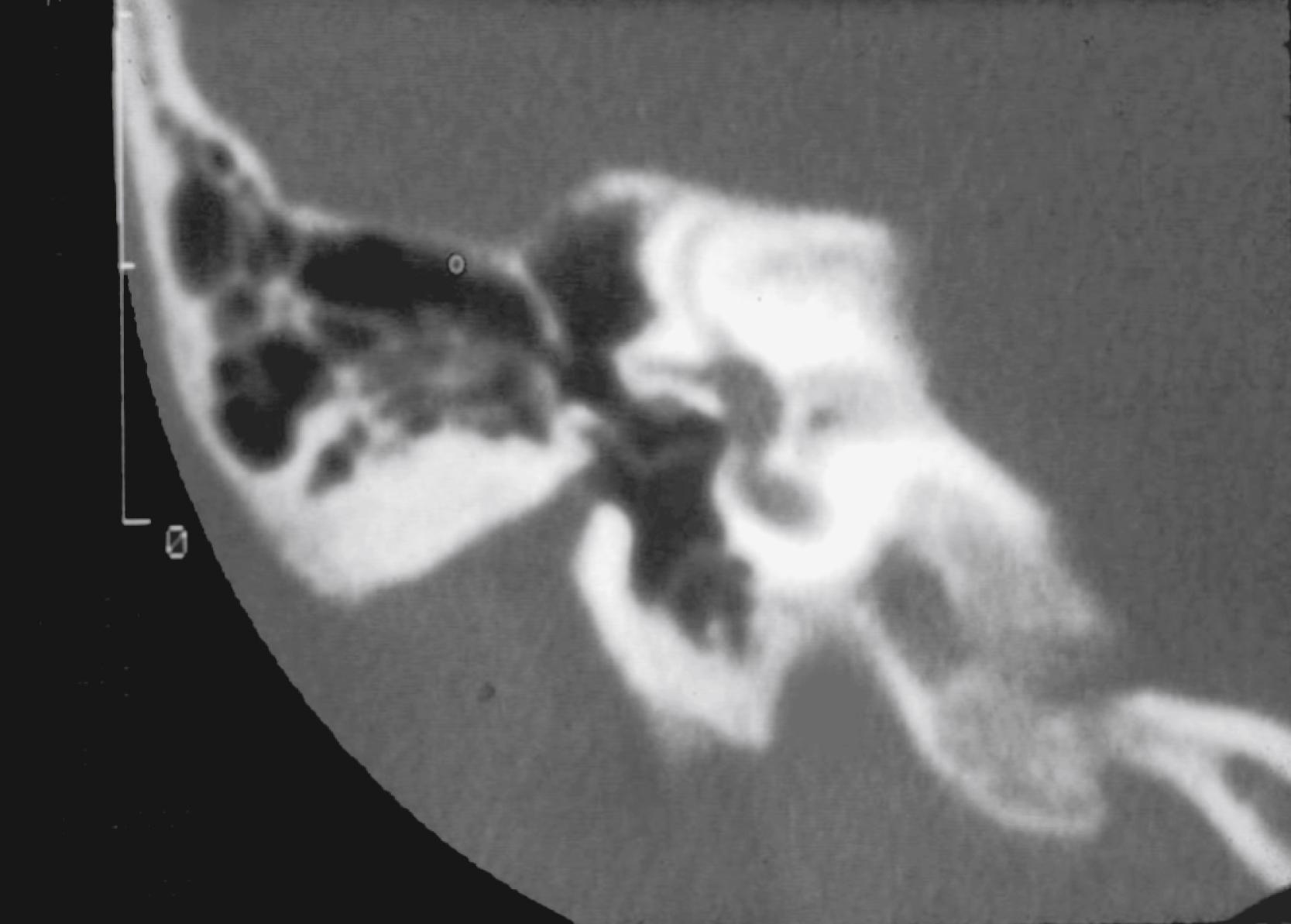 Fig. 4.2, Congenital aural atresia, right ear. Coronal high-resolution computed tomography reveals an atretic external auditory canal and a normally developed mastoid air cell system with a normal inner ear.