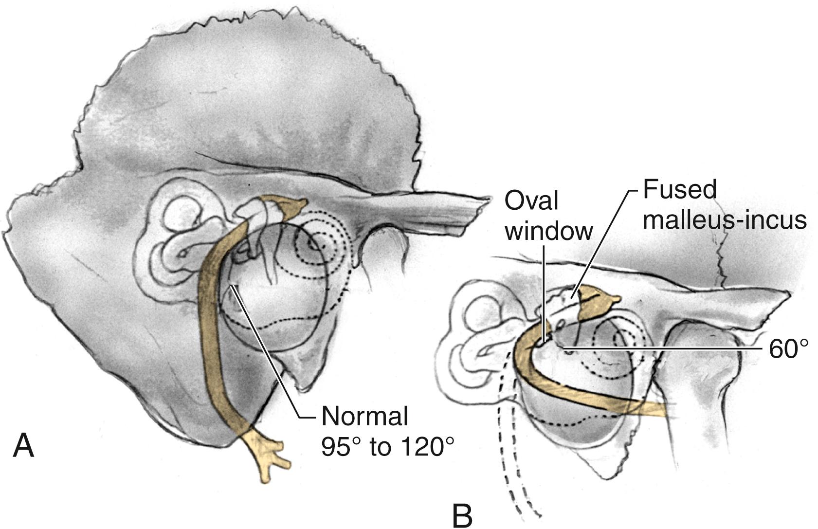 Fig. 4.3, Facial nerve in congenital atresia surgery. (A) Normal intratemporal facial nerve anatomy. (B) Intratemporal facial nerve anatomy in congenital aural atresia.