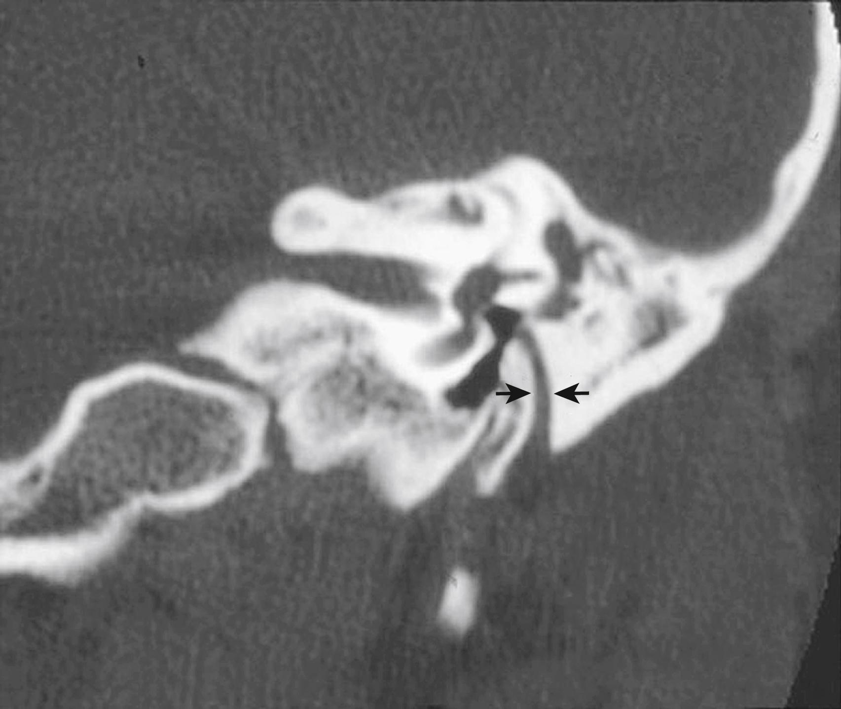 Fig. 4.4, Pitfalls in congenital aural atresia surgery: facial nerve on coronal high-resolution computed tomography. The arrows point to the vertical (mastoid) segment of the facial nerve in the left ear.