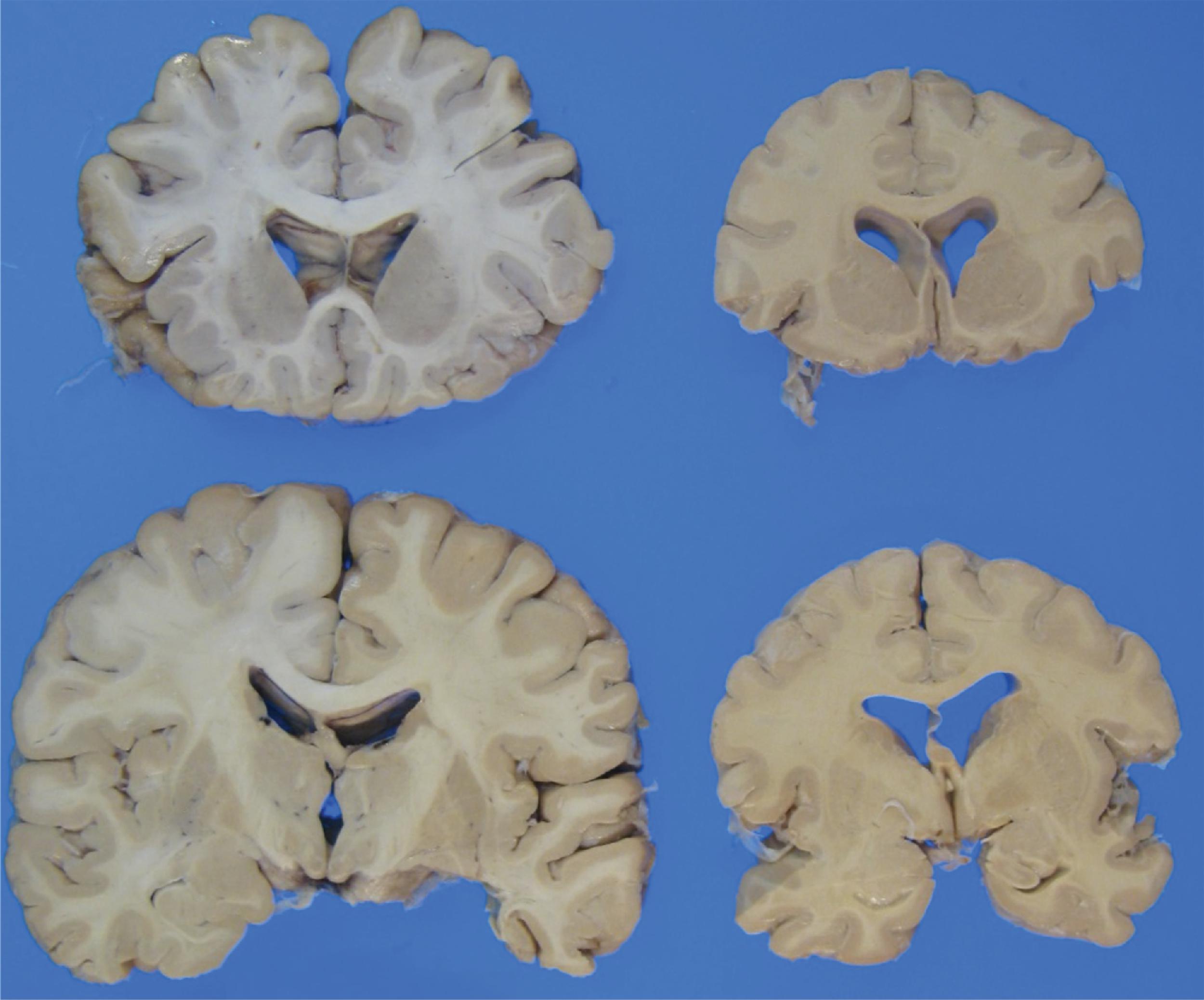 FIGURE 4.1, Micrencephaly: coronal sections of the brain (right) from a 41-year-old female with history of congenital Rubella syndrome. The brain weight was 870 g (average normal for age: 1350 g). Note the absence of malformations. Normal brain weighing 1250 g from a 65-year-old male is shown for comparison.