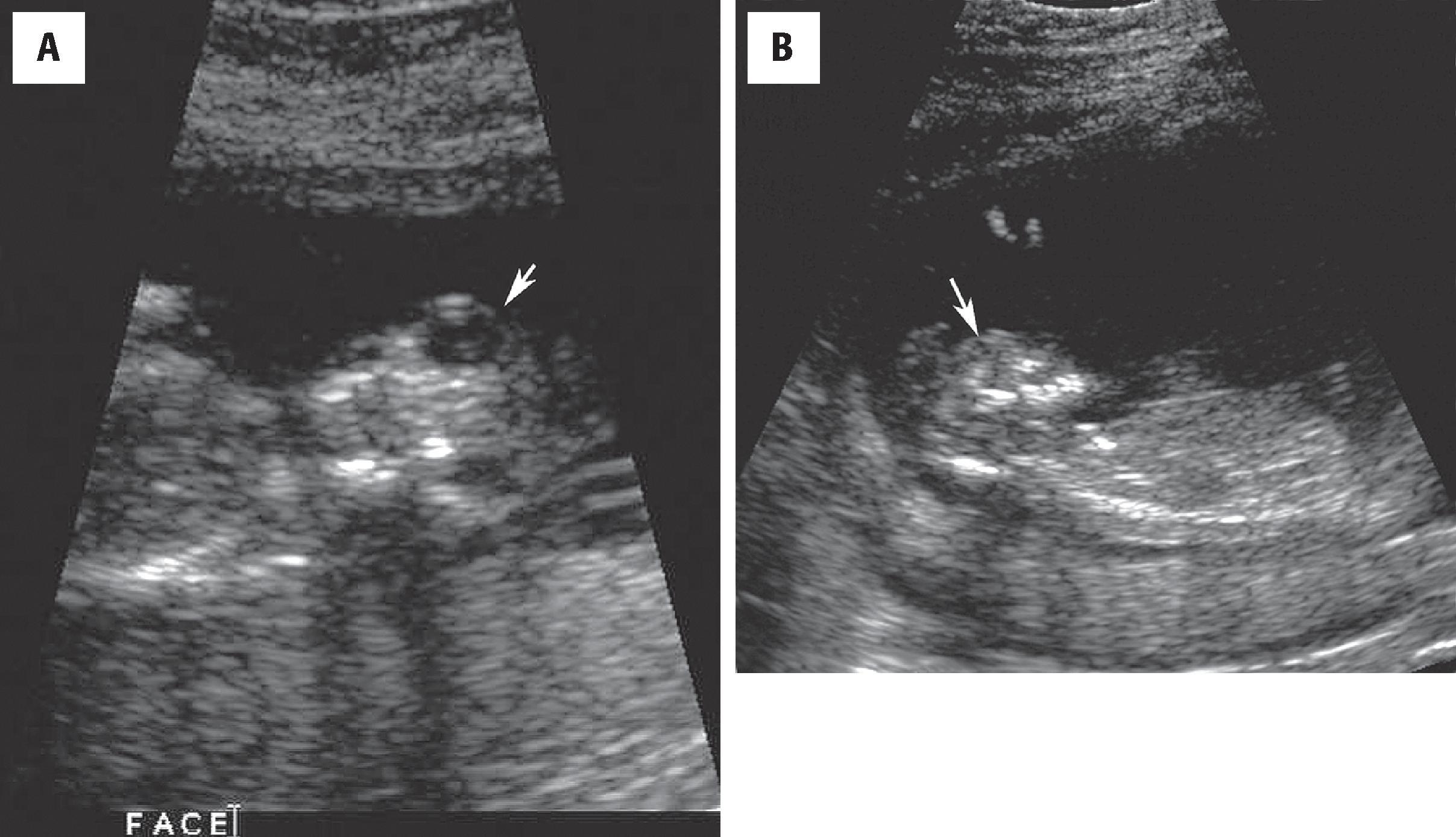 FIGURE 4.11, Anencephaly. ( A and B ) Coronal and sagittal prenatal ultrasound images from the late second trimester showing prominent orbits ( arrow ) and absence of the cranial vault. (Courtesy of Dr. D. Levine, Boston.)