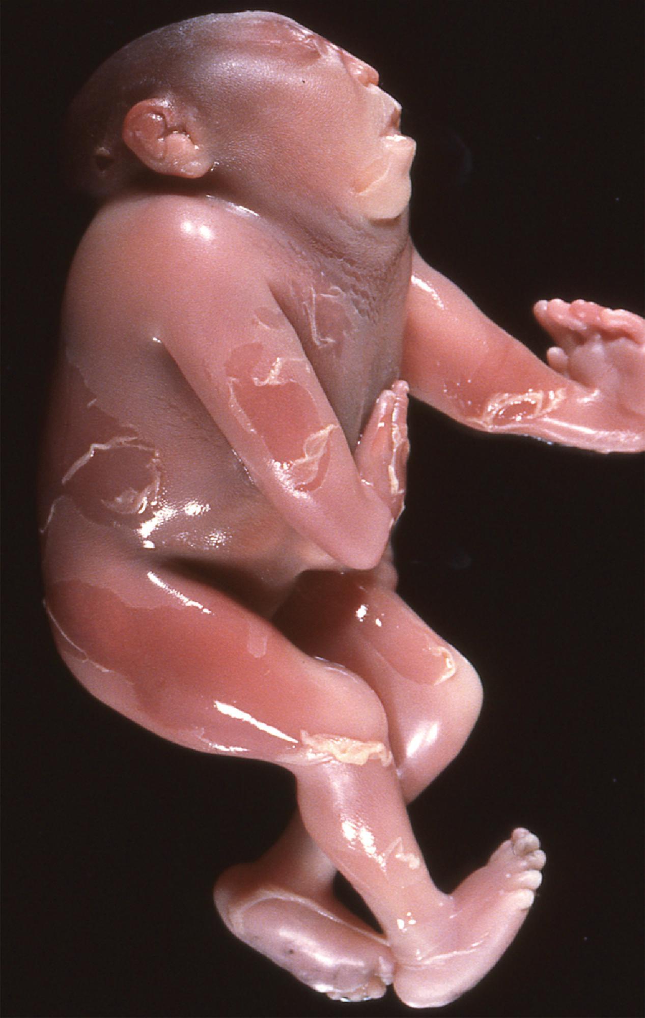 FIGURE 4.12, Iniencephaly is characterized by three common characteristics: a defect in the occipital bone, spina bifida of the cervical vertebrae, and retroflexion of the head on the cervical spine. (Courtesy of the late Dr. Robert H. Shikes, Denver.)