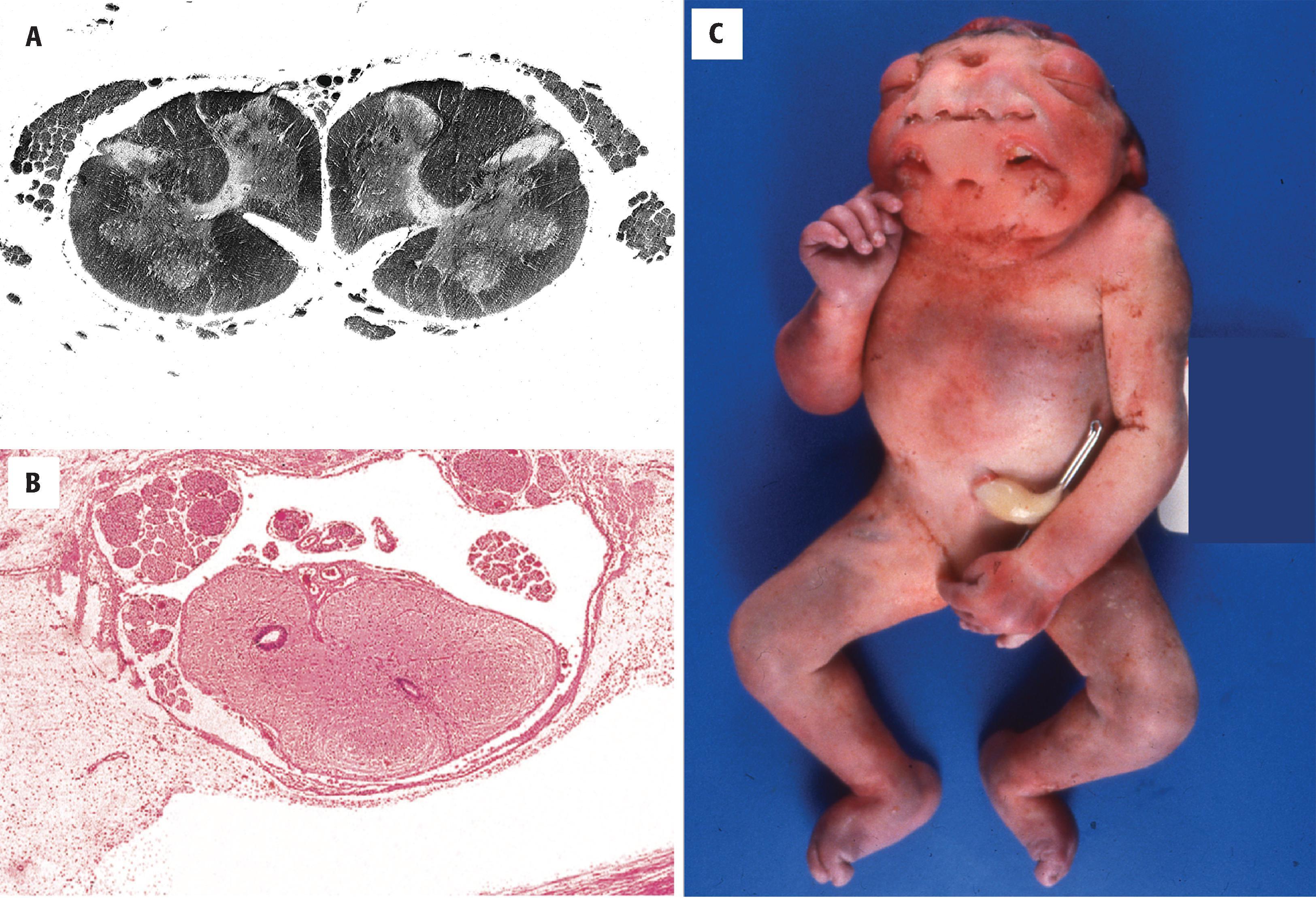 FIGURE 4.13, Neural tube duplications. ( A ) Diplomyelia. Rarely, neural tube closure abnormalities may be manifested by nearly complete duplication of the spinal cord. (Courtesy of Dr. U. De Girolami, Boston .) ( B ) Partially duplicated spinal canal (diastematomyelia) in a 20-week-gestation fetus with an open lumbosacral spinal defect. ( C ) Diprosopus (Latin: two-faced), an extremely rare condition in which facial features are duplicated to variable degree, but there is a single normal trunk and normal limbs. This malformation is likely to arise from abnormal patterning from an increase in the expression of the protein sonic hedgehog, which is essential for craniofacial patterning during development. In this case, complete duplication of nose, oral cavity, and an extra orbit can be observed with normal trunk and limbs.