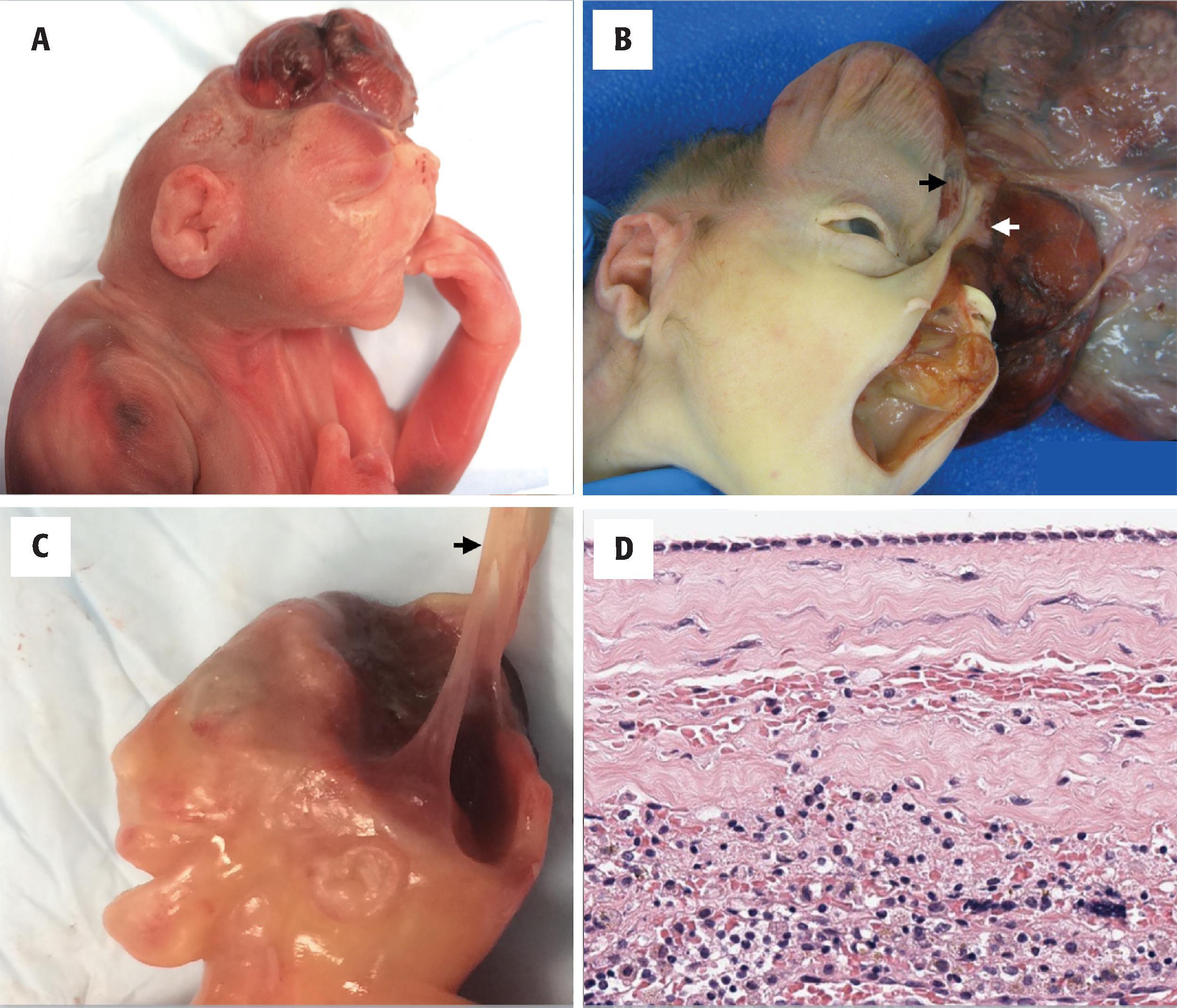 FIGURE 4.14, Amniotic band sequence. Although resembling anencephaly, these fetuses acquired facial and cranial disruption from constricting bands of amnion ( arrows in B and C ) and do not have a true neural tube defect. Amputation of the fingers (as seen on the right hand in the case shown in panel A ) or of other body parts can hint at the diagnosis. ( D ) Hematoxylin and eosin–stained section showing amniotic band with diagnostic single-layered cuboidal amniotic epithelium and mesenchyme with underlying necrotic brain and aggregates of macrophages.