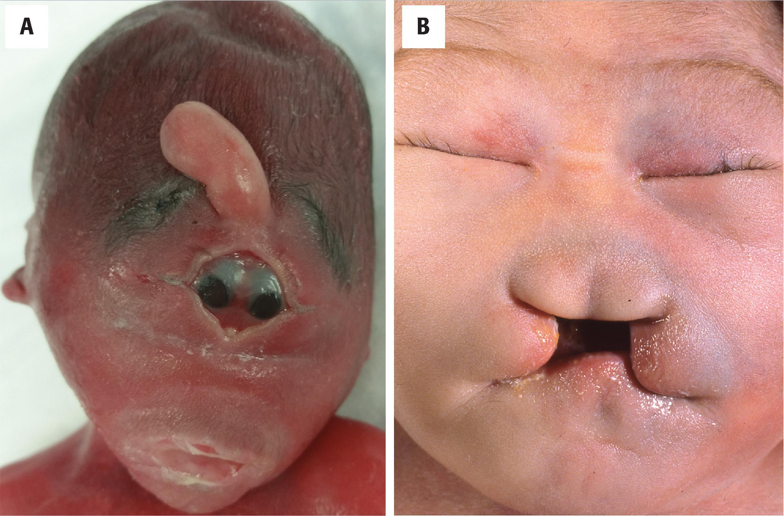 FIGURE 4.15, Holoprosencephaly, facial anomalies ( A ) Cyclopia: 20-week-gestation electively aborted fetus for holoprosencephaly with a single orbit, fused eyes, and proboscis. ( B ) Midline facial cleft and hypotelorism (close-set eyes) in a patient with trisomy 13 and semilobar holoprosencephaly.