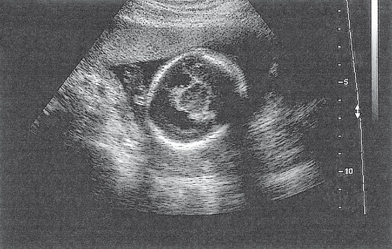 FIGURE 4.16, Alobar holoprosencephaly: second-trimester fetal magnetic resonance imaging, axial view, showing paired diencephalic structures but no interhemispheric fissure or lobes.