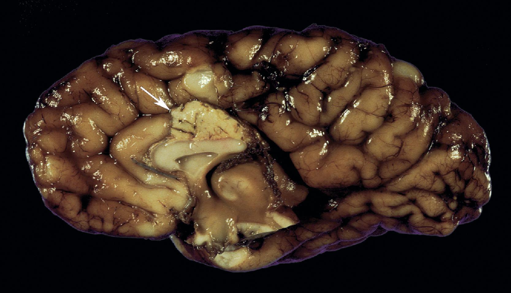 FIGURE 4.17, Partial agenesis of the corpus callosum: midsagittal view of the left hemisphere showing preservation of the rostrum of the corpus callosum but absence of the body and genu, which have been replaced by a midline lipoma ( arrow ).