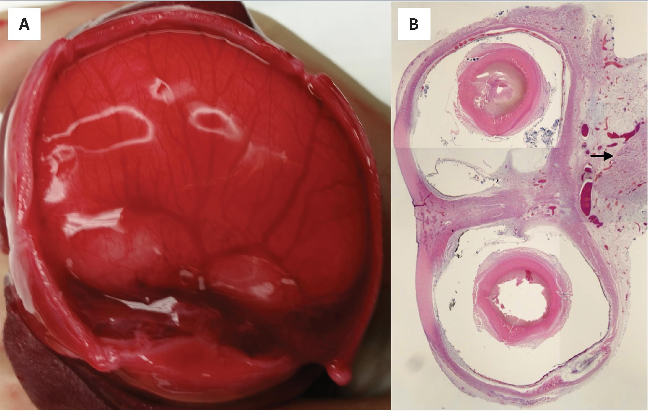 FIGURE 4.18, Holoprosencephaly, alobar. ( A ) Superior view of the brain in a second trimester fetus who was electively terminated for severe brain abnormalities. Upon removing the cranial cap, complete fusion of the hemispheres can be observed. ( B ) Hematoxylin and eosin–stained section of the fused eyes from case shown in A. Notice the single fused optic nerve (arrow) .