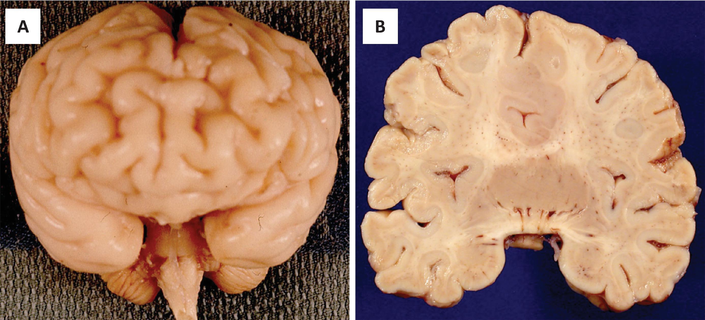 FIGURE 4.19, Holoprosencephaly, semilobar. ( A and B ) Semilobar holoprosencephaly represents partial absence of interhemispheric fissure, which is absent anteriorly but present posteriorly in this case. ( B ) Coronal section of the brain from a patient with semilobar holoprosencephaly showing partial division of the cerebral hemispheres but complete fusion of the diencephalic structures. The cortical gray matter is partially fused, and a well-defined corpus callosum is not seen.