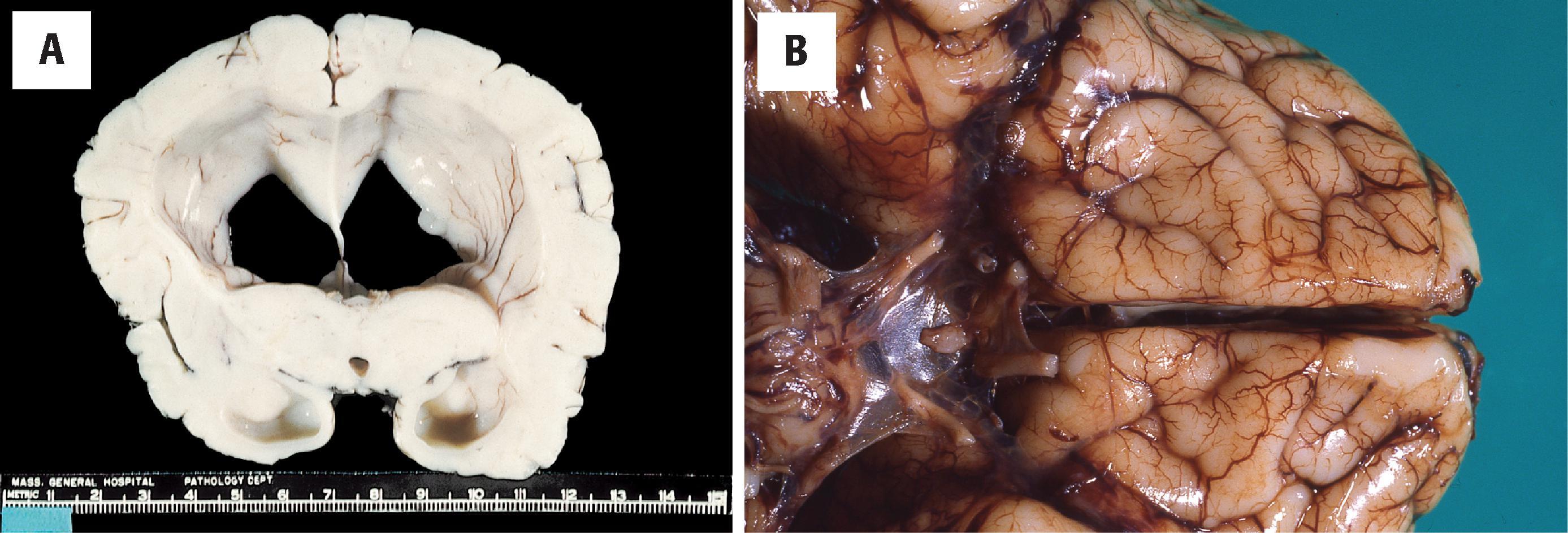 FIGURE 4.20, Holoprosencephaly (HPE), lobar, and arhinencephaly. ( A ) Lobar HPE. Coronal section with fusion of the dorsal aspect of the thalamus and a small third ventricle. There is complete separation of the hemispheres into recognizable lobes, and the corpus callosum is present, although thinned; the ventricles are expanded. ( Courtesy of Dr. U. De Girolami, from the collection of the late Dr. E. P. Richardson, Jr., Boston.) ( B ) A ventral view of the orbitofrontal cortex showing arhinencephaly or absence of the olfactory bulbs and tracts, which represent a mild manifestation within the HPE spectrum but should not be considered HPE without accompanying midline and fusion defects.