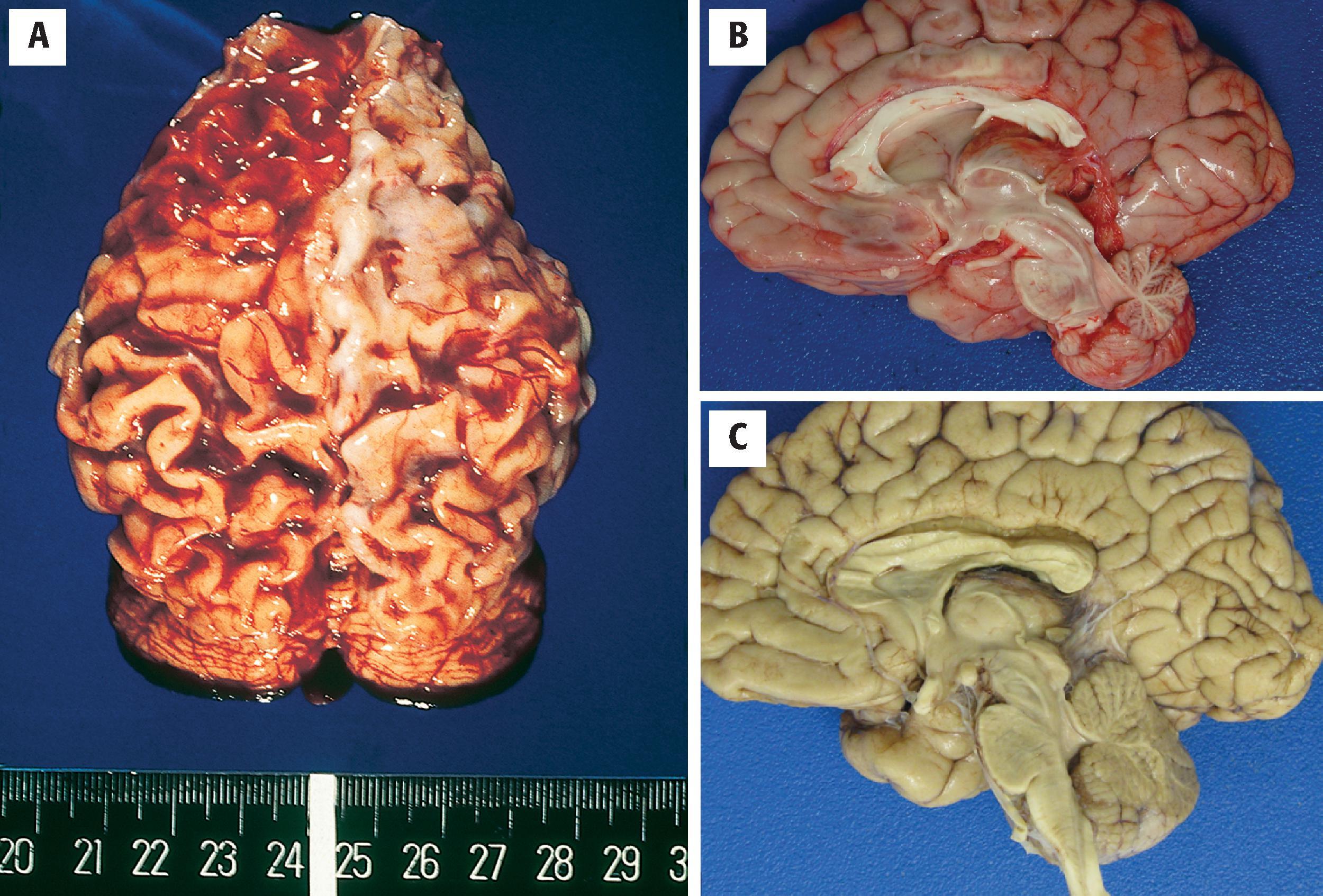 FIGURE 4.2, Micrencephaly: ( A ) Dorsal view of a micrencephalic brain from a 7-year-old girl with microcephaly and developmental delay from birth. Note the widened sulci and narrow gyri indicative of atrophy, as well as poor brain growth. ( B and C ) Other cases may show relatively normal–looking brain with overall proportionally reduced size and weight as compared with age-matched controls. ( B ) A 9-year-old old female with homozygous WDR73 mutation. The brain was micrencephalic weighing 725 g. The cerebellum is disproportionately hypoplastic. ( C ) Sagittal section through a 16-year-old male with Aicardi-Goutier syndrome. The brain weighed 916 g, lower than normal expected for age (>1350 g).