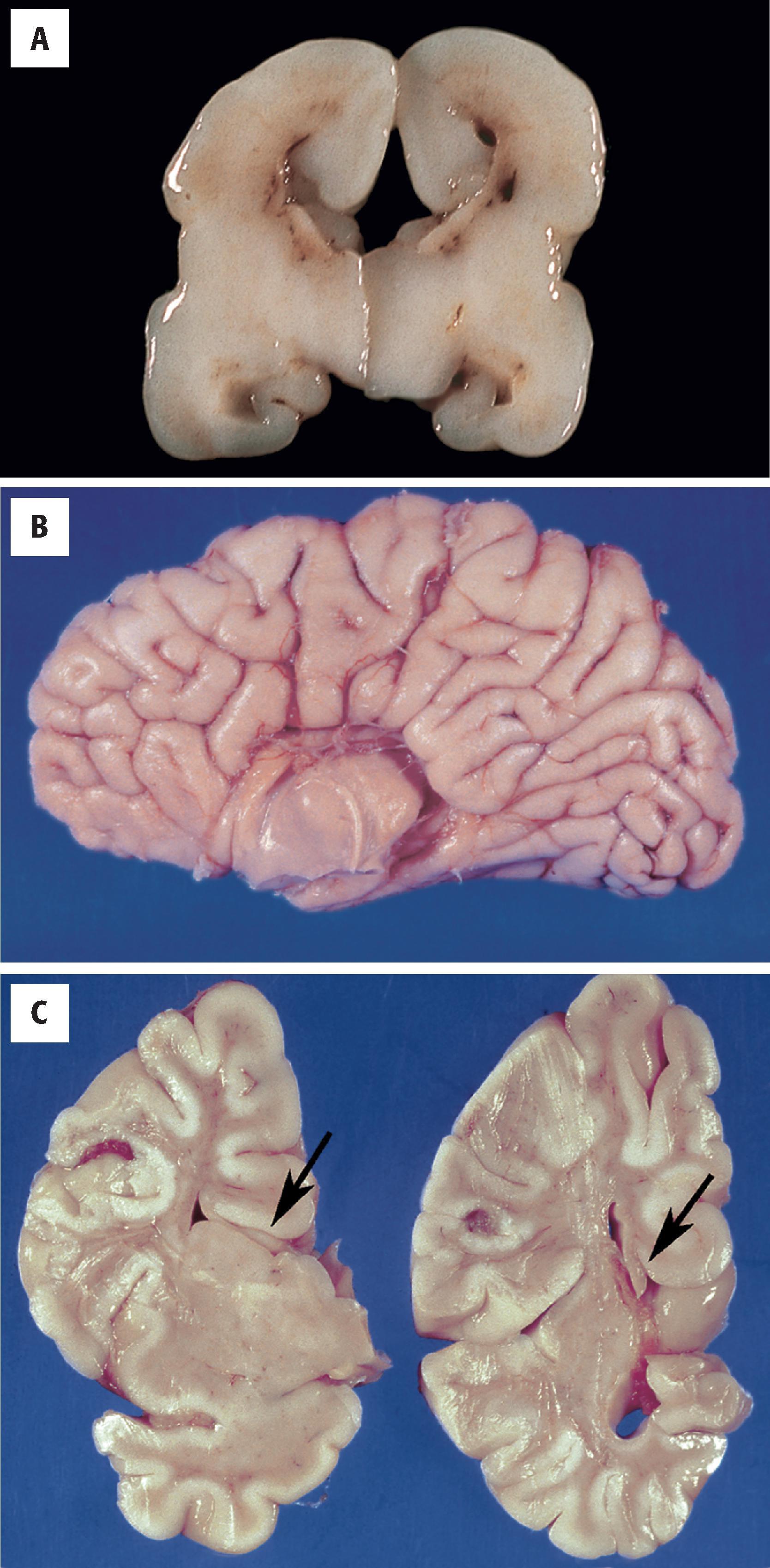 FIGURE 4.21, Complete agenesis of the corpus callosum. ( A ) Coronal section from an 18-week-gestation fetus showing vertical (“bat wing”) orientation of the lateral ventricles. ( B ) Midsagittal section of the right hemisphere from an infant; note the appearance of radiating gyri resulting from absence of the cingulate gyrus and corpus callosum. ( C ) Coronal section of the left lateral hemisphere illustrating the vertical ventricular profile and a Probst bundle ( arrow ).