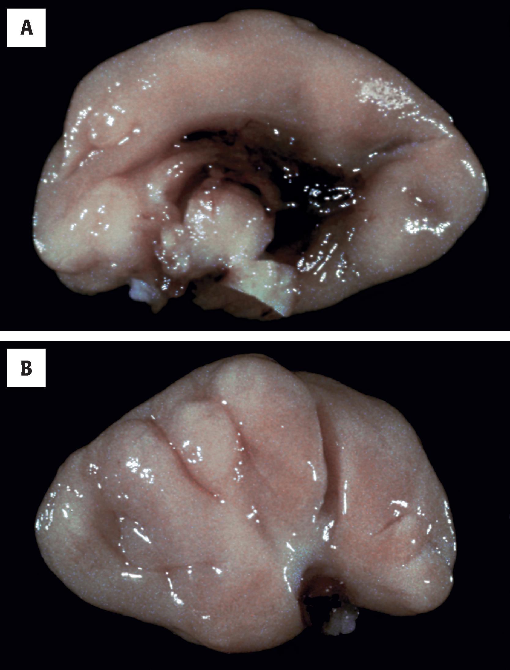FIGURE 4.22, Aicardi syndrome. ( A ) Medial view of the right hemisphere from a 22-week-gestation fetus showing absence of the corpus callosum. ( B ) On lateral view, abnormal cortical gyration is seen in the parietal region.