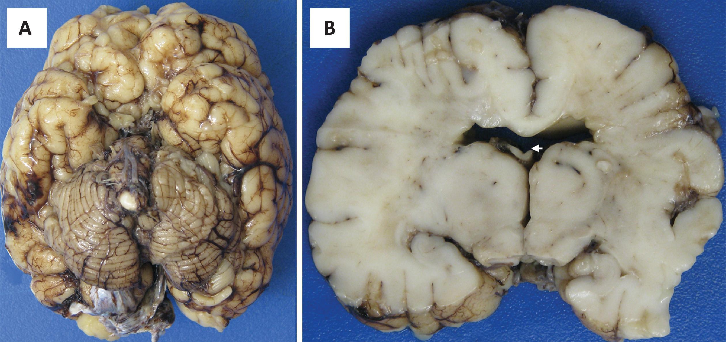 FIGURE 4.23, Septo-optic dysplasia. ( A ) View of the base of the brain showing absence of the olfactory bulbs and tracts and small optic nerves and chiasm. Although olfactory bulbs can be artifactually disrupted during brain harvesting, the absence of the olfactory grooves and the gyri recti can aid in identifying the abnormality. ( B ) Coronal section of the hemispheres reveals absence of the septum pellucidum, a condition lending a “monoventricle” appearance. The fornix (arrow ) is free floating in the ventricle.