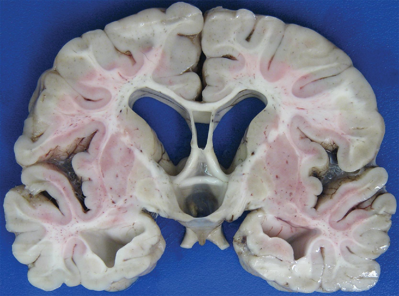 FIGURE 4.24, Cavum septi pellucidi. Note the widened leaves of the septum in this 5-year-old male with micrencephaly, hydrocephalus, and white matter atrophy of unknown etiology.