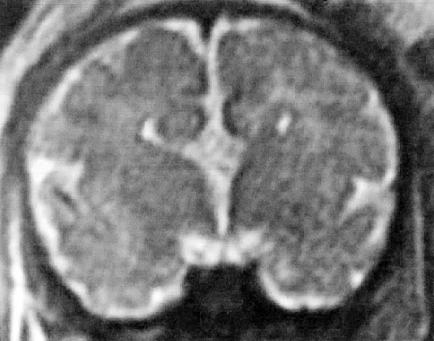 FIGURE 4.25, Agenesis of the corpus callosum: fetal magnetic resonance imaging showing the “bat wing” ventricles.