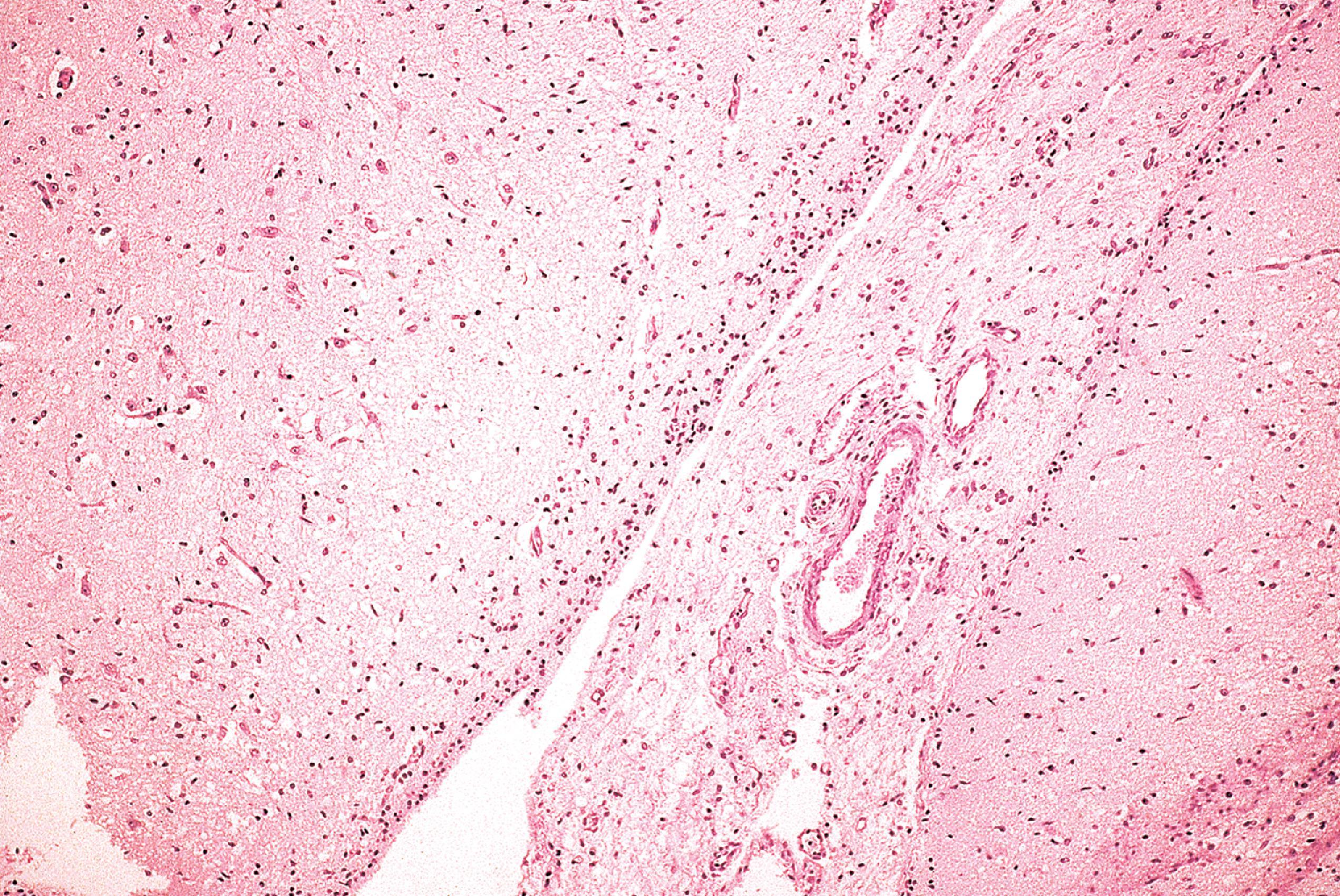 FIGURE 4.27, Subarachnoid glioneuronal heterotopia: histologic section of cerebral cortex with heterotopic tissue in the subarachnoid space surrounding subarachnoid vessels.