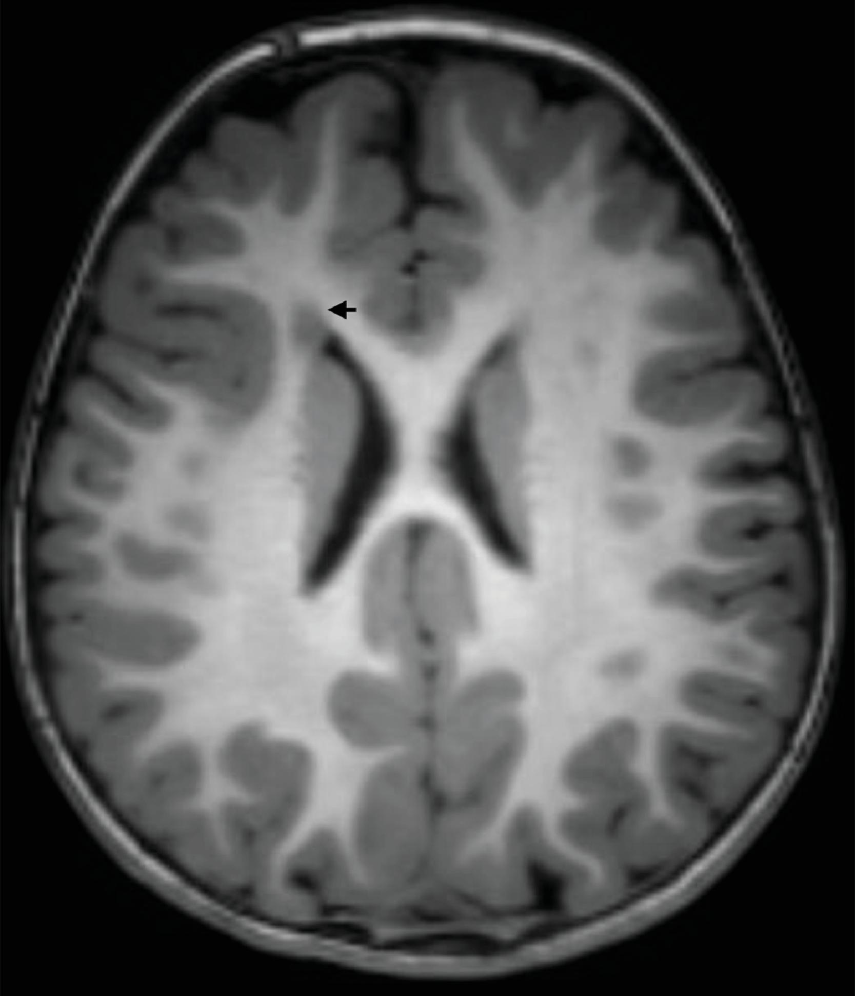 FIGURE 4.29, Periventricular nodular heterotopia. Single focus of periventricular nodular heterotopia in the right frontal lobe ( arrow ).