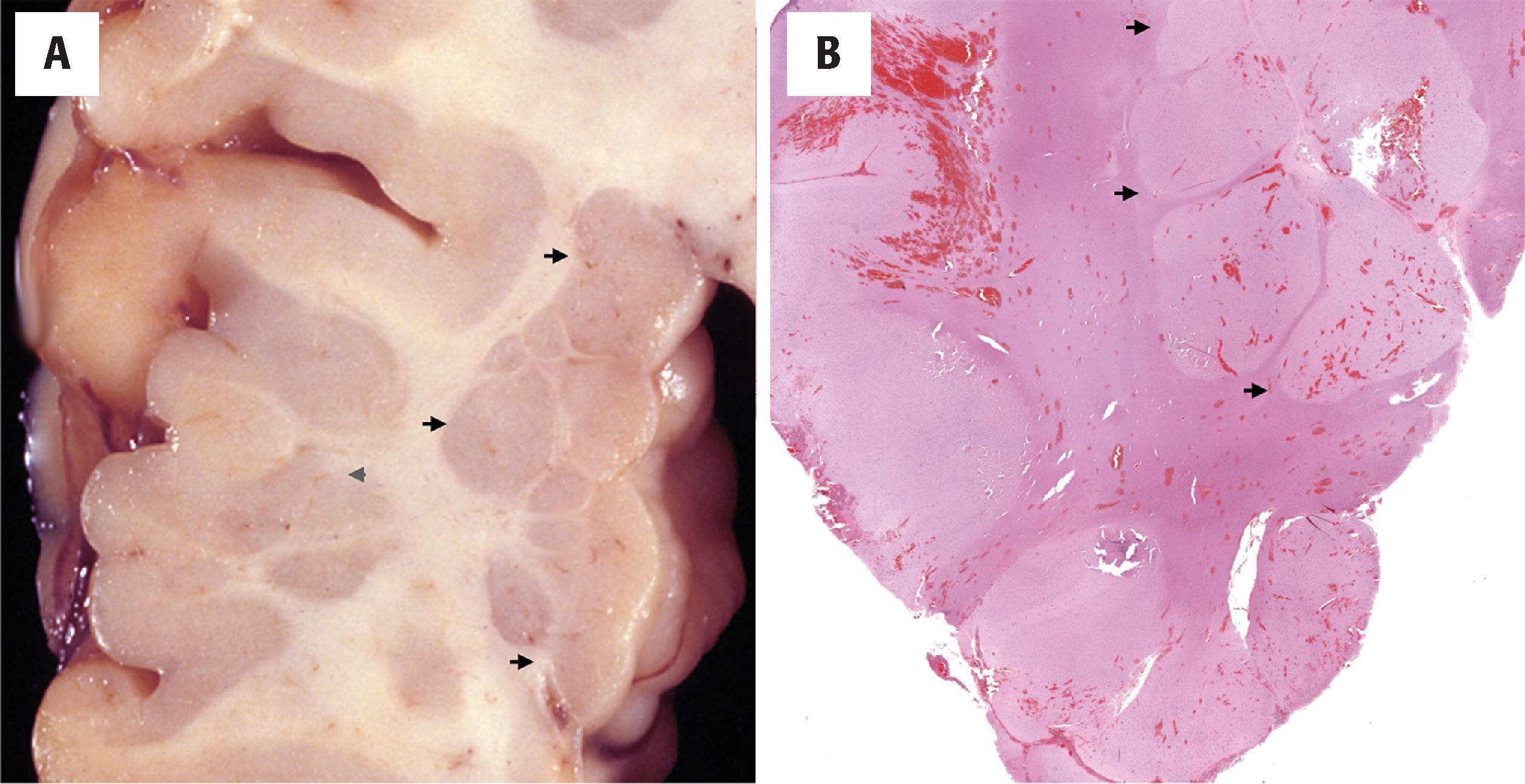 FIGURE 4.30, Periventricular nodular heterotopia. ( A ) Periventricular gray matter heterotopia in subependymal ( arrows ) and subcortical locations ( arrowhead ). ( B ) Hematoxylin and eosin–stained section showing several glioneuronal nodules ( arrows ) present in the periventricular white matter.