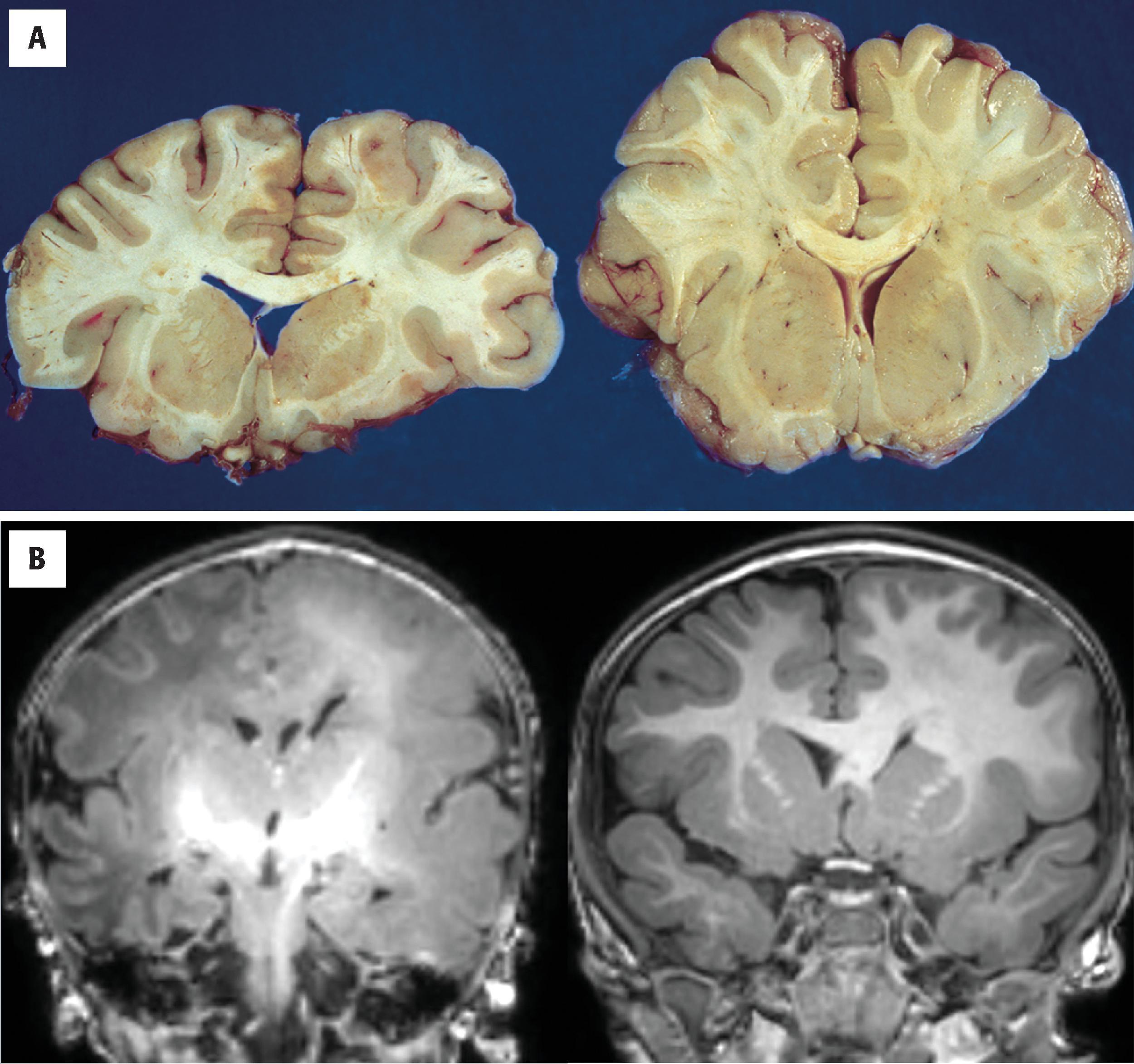 FIGURE 4.3, ( A ) Megalencephaly: coronal sections of a proportionally enlarged brain ( right ) next to a normal-sized control ( left ) at the level of the corpus striatum. (Courtesy Dr. C. Pierson, Columbus.) ( B ) Hemimegalencephaly. Coronal MRI of the brain in two different patients each with left-sided hemimegalencephaly.