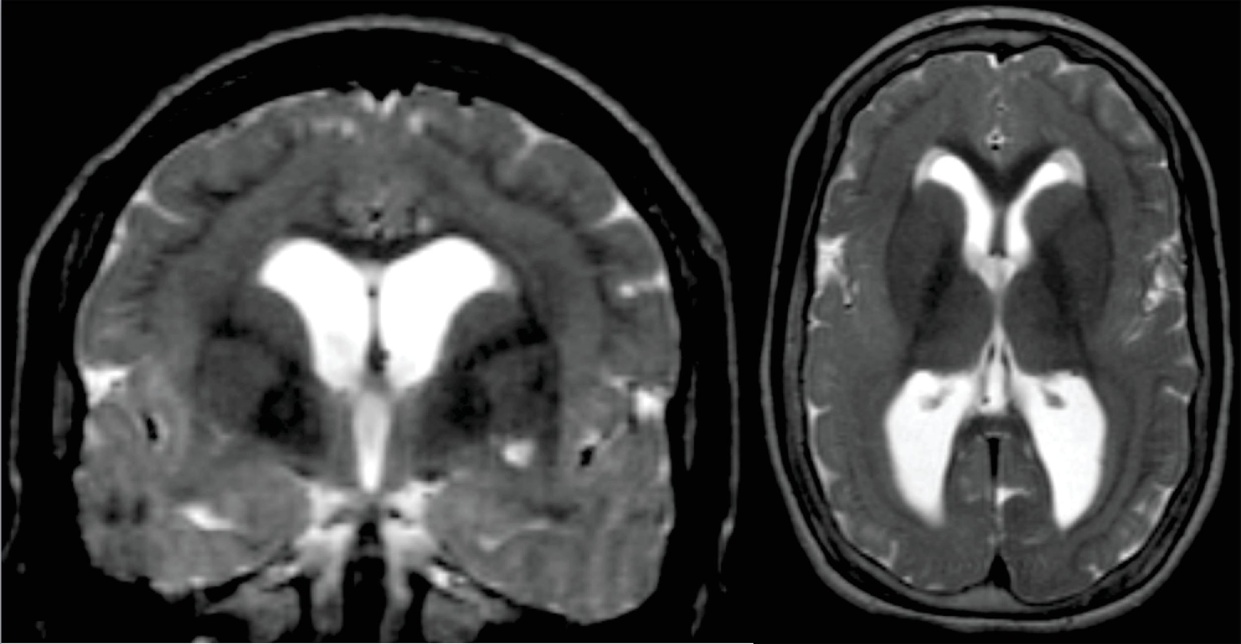 FIGURE 4.31, Subcortical-band heterotopia. Coronal and axial magnetic resonance imaging in a 17-year-old with lissencephaly with band heterotopia. Notice thick bands of gray matter separated by thin layers of white matter from the cortex, indicating subcortical band heterotopia. The brain surface is smooth (lissencephalic), and sulci between the gyri are markedly shallow. White matter is severely reduced in comparison with the gray matter. Ventriculomegaly is present. Doublecortin is present in >80% of sporadic cases of subcortical band heterotopia (SBH) and virtually all familial case. Although females with DCX gene mutations show SBH while males show lissencephaly, this example is from a male, highlighting that rare cases of males with SBH do occur.