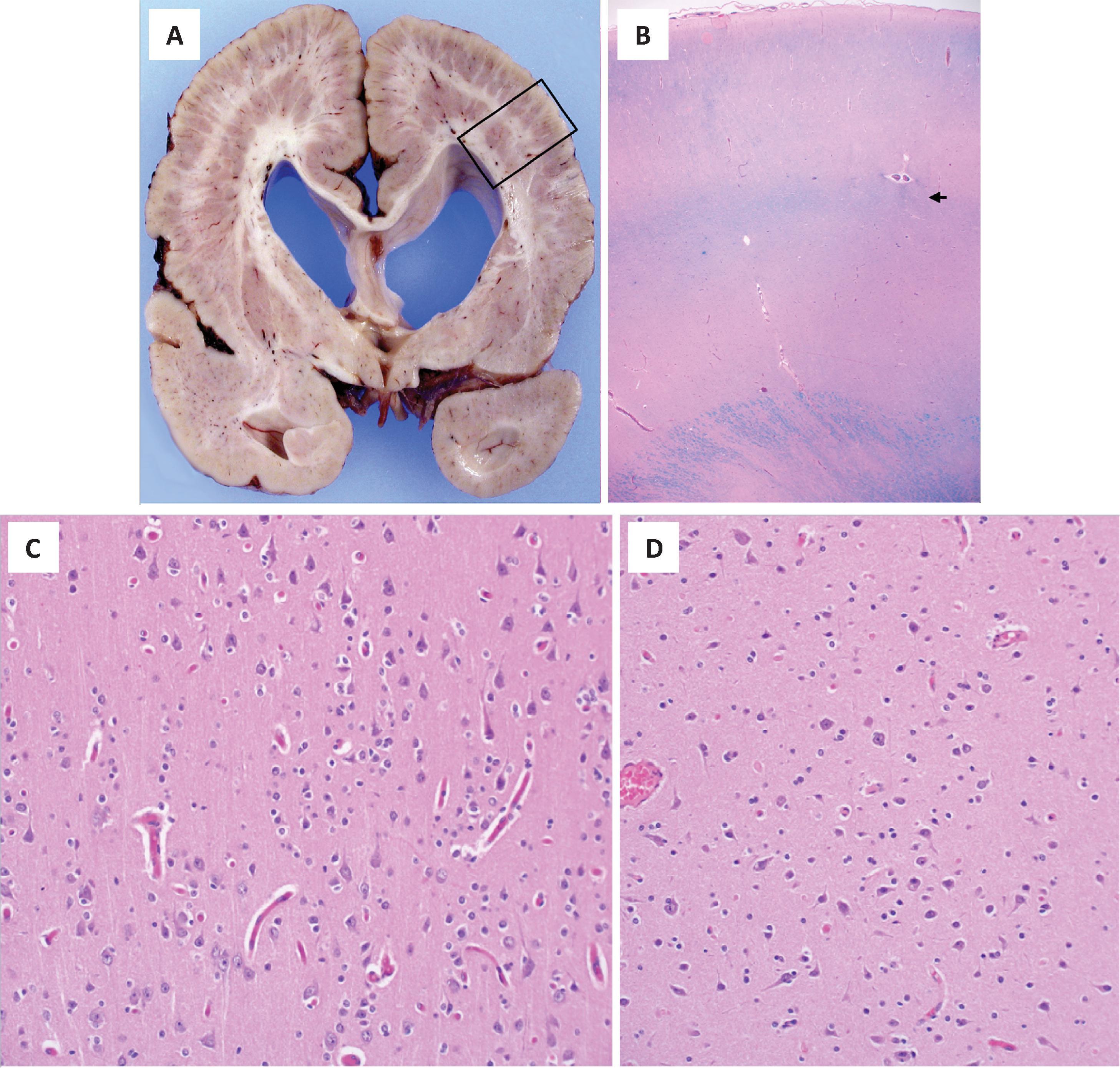 FIGURE 4.32, Subcortical-band heterotopia. ( A ) Coronal section at autopsy showing diffuse lissencephaly and a band of heterotypic white matter occupying the white matter. (Courtesy Dr. BK Kleinschmidt-DeMasters, Denver.) ( B ) Luxol fast blue–PAS stained section highlights the cortex followed by a thin layer of white matter ( arrow ) beneath which a band of glioneural tissue can be seen. ( C and D ) Higher magnification view shows cortex with mostly preserved cortical architecture with only mild architectural abnormalities. The subcortical band on the other hand ( D ) showed no recognizable neuronal lamination.