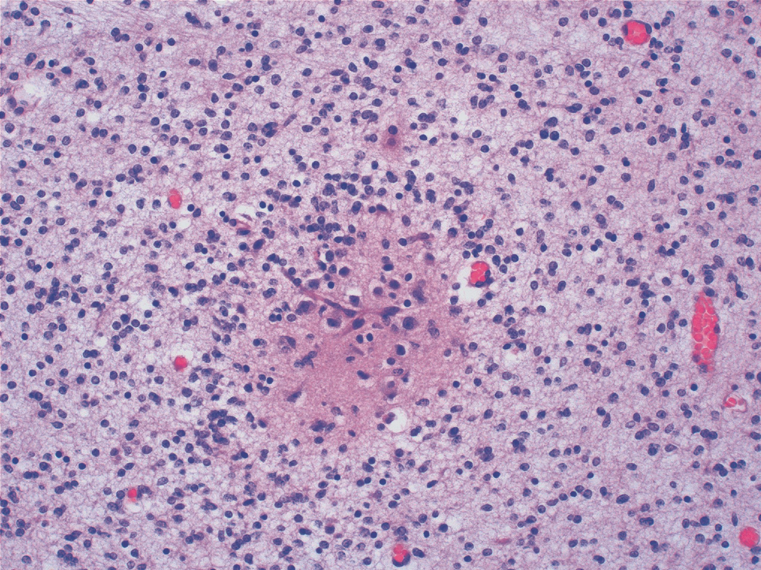 FIGURE 4.33, Cerebellar heterotopia: collection of small granule cells and large Purkinje-like neurons in the deep cerebellar white matter.