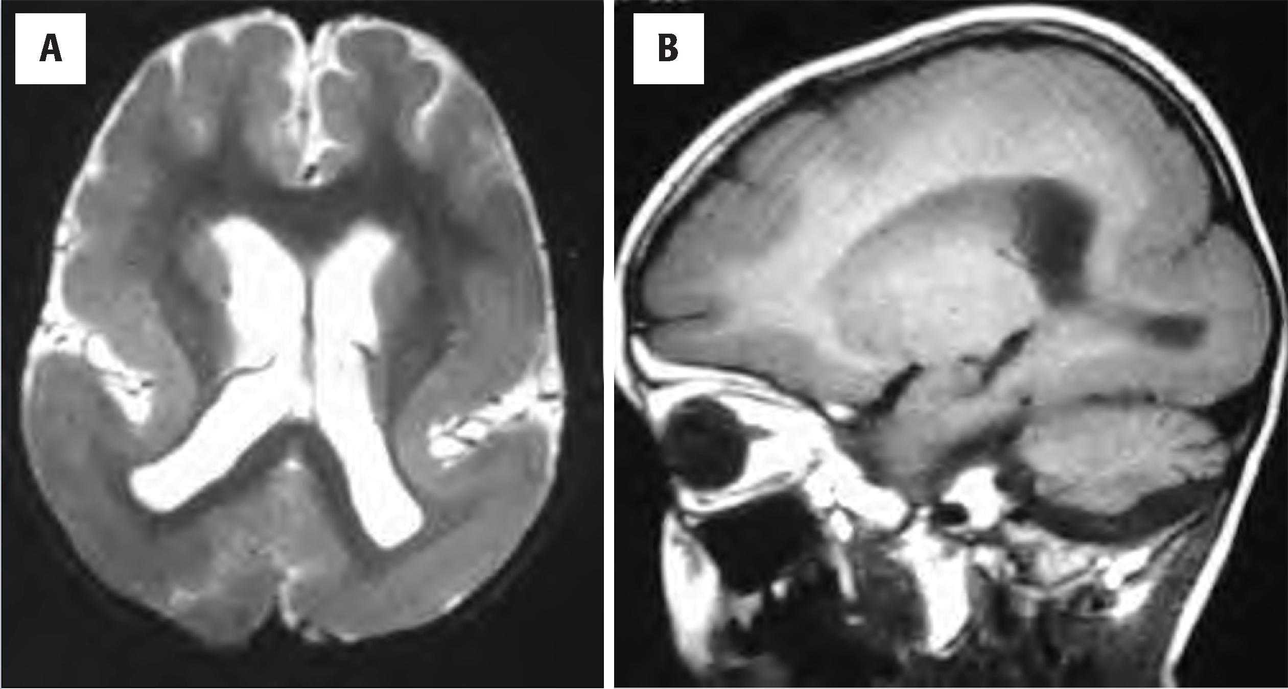 FIGURE 4.34, Lissencephaly. ( A and B ) Axial and sagittal magnetic resonance imaging in a child with seizures showing rudimentary gyri in the frontal part of the brain while the posterior aspect shows almost complete absence of gyration and a thick cortical mantle.