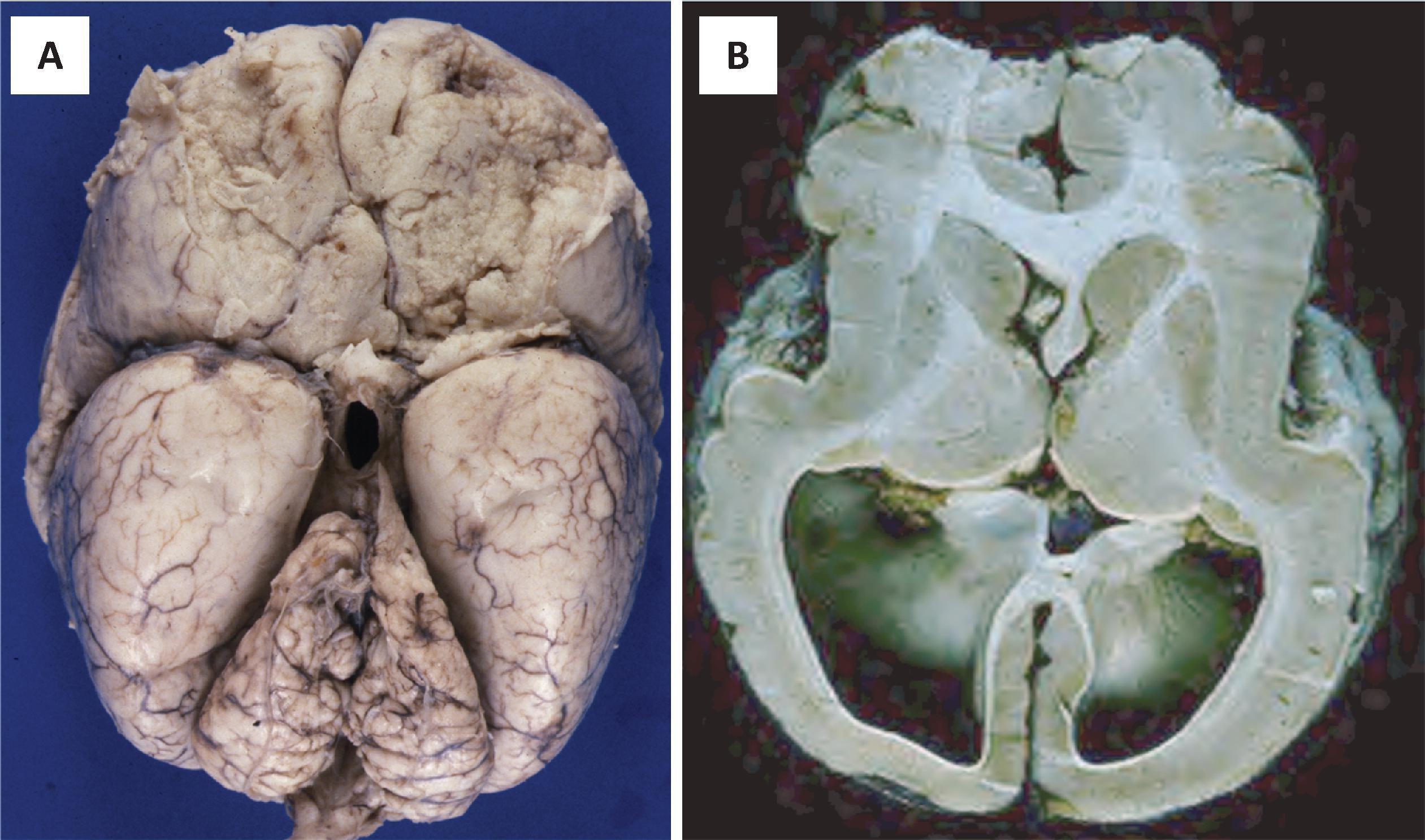 FIGURE 4.35, Lissencephaly. ( A ) Smooth lissencephalic ventral surface of the brain at autopsy for the case shown in Fig. 4.34 . ( B ) Axial section showing thick pachygyric smooth cortex. The anterior aspect of the cortex is relatively less affected and shows rudimentary gyri. (Courtesy Dr. BK Kleinschmidt-DeMasters, Denver.)