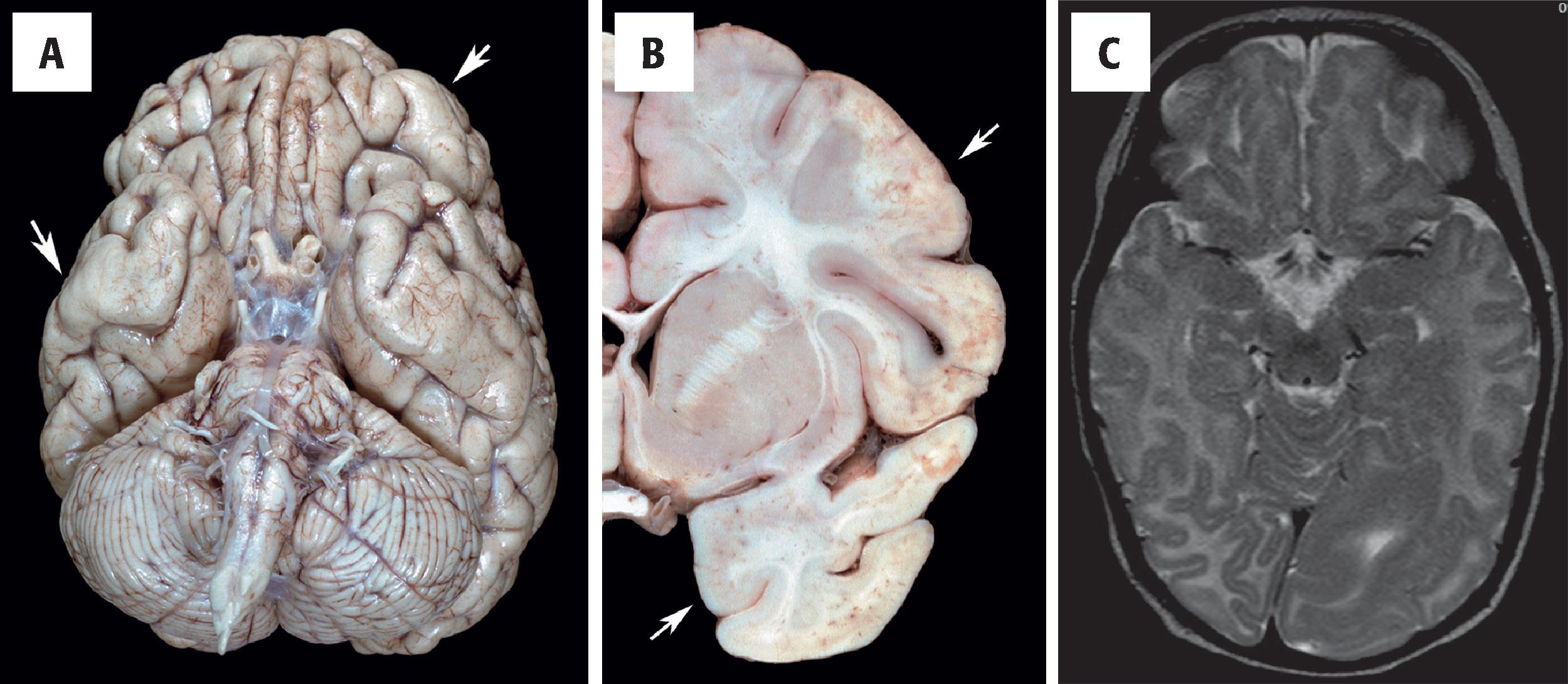 FIGURE 4.36, Pachygyria. ( A ) Basal view showing thickening of the lateral frontal and inferior temporal lobe gyri bilaterally ( arrows ). ( B ) Coronal section of the right hemisphere at the level of the striatum with a thick lateral frontal and inferior temporal cortex ( arrows ). ( C ) Left occipital focal hemimegalencephaly and pachygyria in a case of 2-month-old infant with large hypopigmented patches over his trunk and thigh; the clinical diagnosis of hypomelanosis of Ito was made.