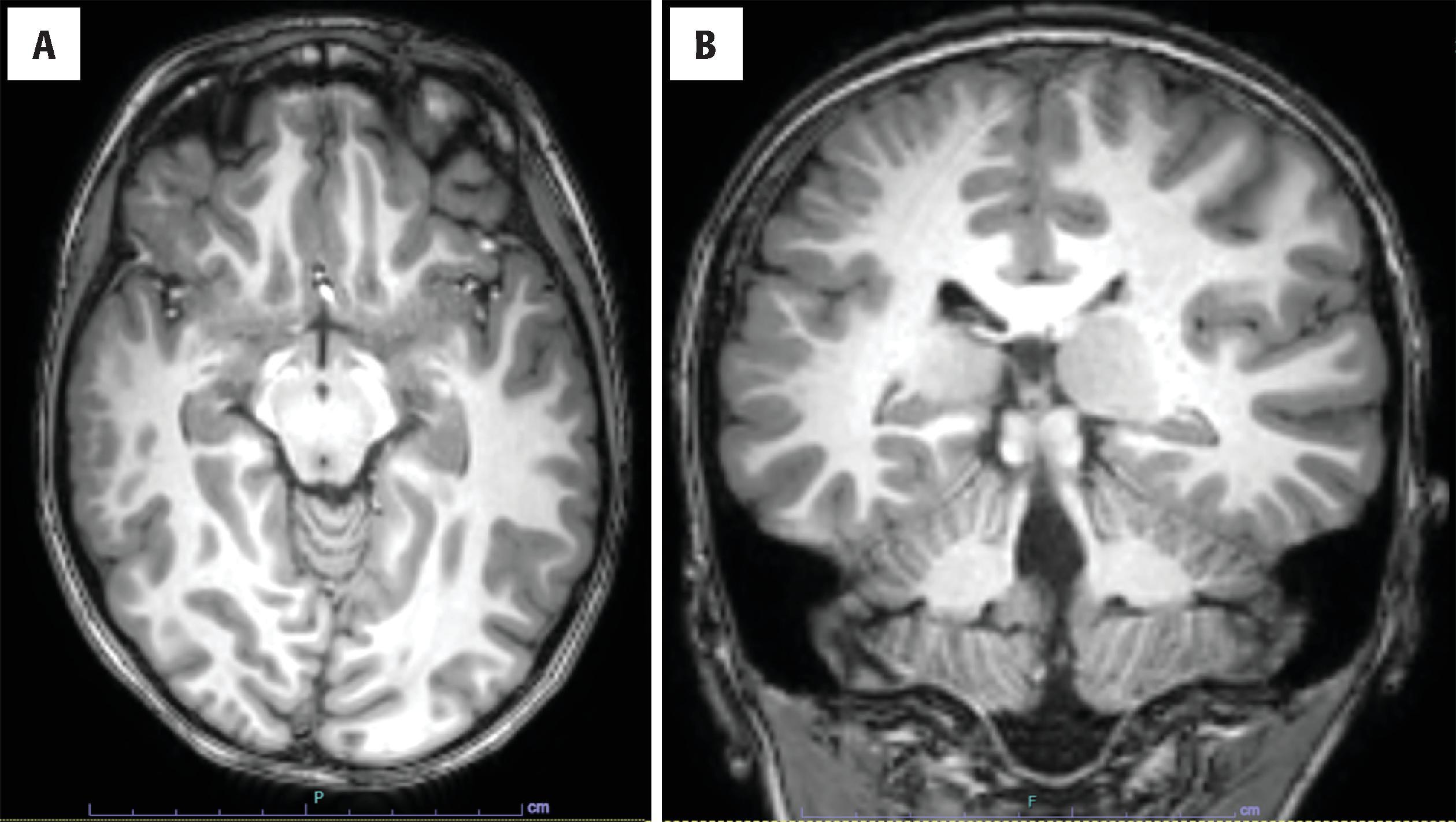 FIGURE 4.37, Polymicrogyria. ( A and B ) Axial and coronal magnetic resonance imaging showing right frontoparietal cortex with multiple small complex gyri.