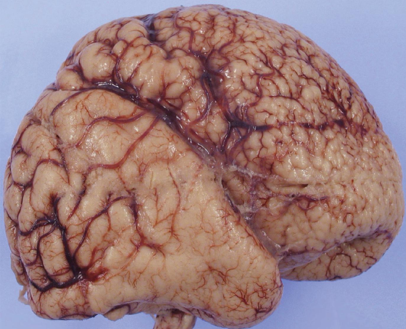 FIGURE 4.38, Polymicrogyria. External surface of the brain shows a fine bumpy appearance resembling Moroccan leather or cobblestones. The posterior part of the cerebrum shows relatively normal gyration.