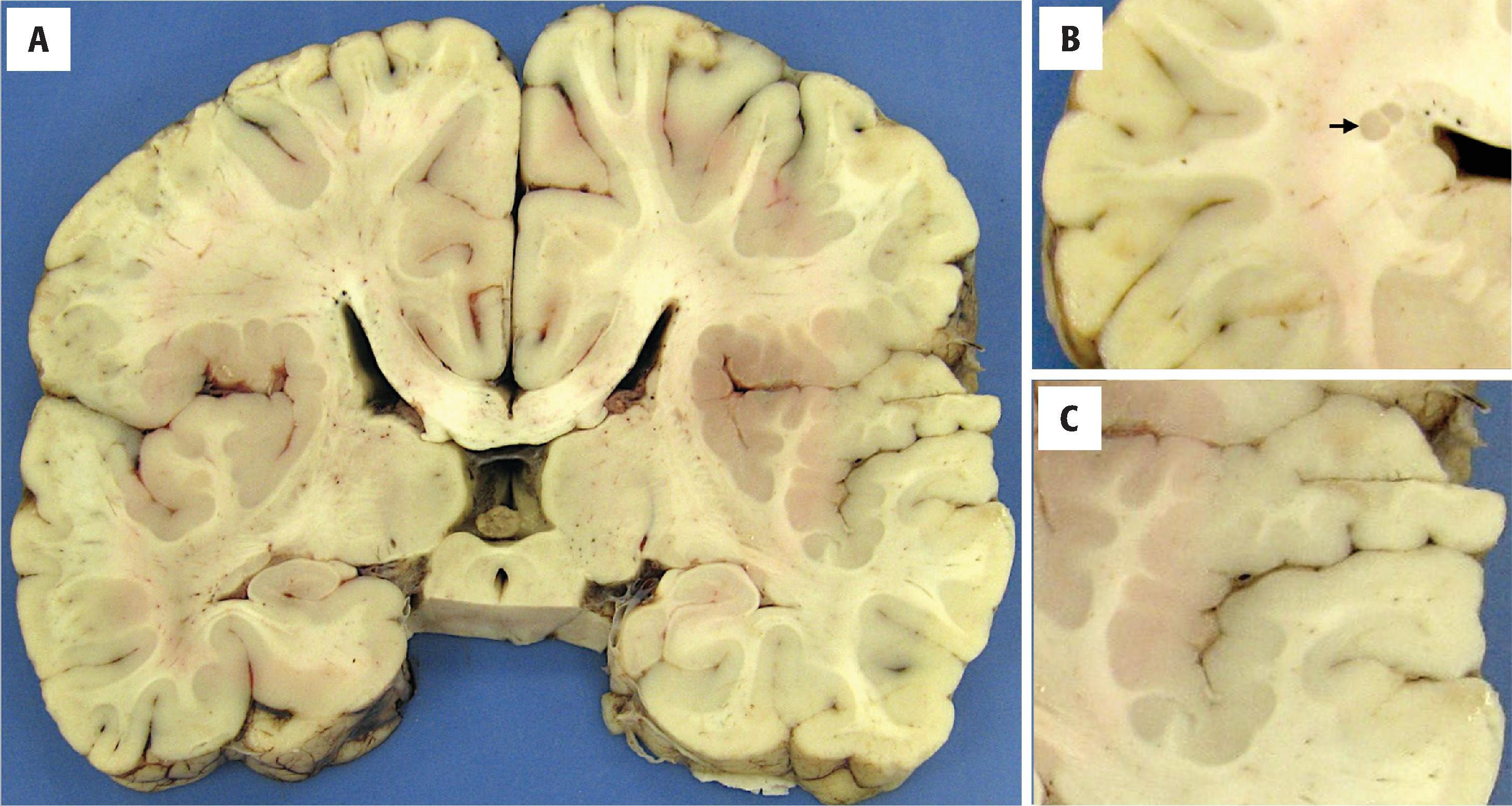 FIGURE 4.39, Polymicrogyria. ( A and C ) Another case of polymicrogyria showing bilateral Sylvian sulcus involvement. ( B ) Periventricular heterotopic gray matter ( arrow ) was seen in the same patient, as is frequently the case.