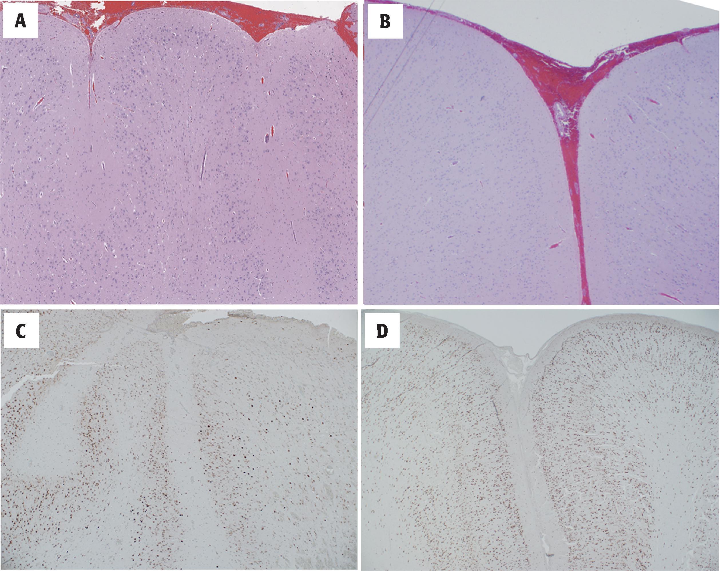 FIGURE 4.40, Polymicrogyria. ( A ) Hematoxylin and eosin–stained sections showing narrow gyri with fusion of cortical layer 1 across adjacent gyri. As compared with gyri in a normal part of the cortex ( B and D ), adjacent gyri in polymicrogyria ( A and C ) fail to show intervening leptomeninges (congested leptomeningeal blood vessels and procedural hemorrhage accounts for the red color). The cortical ribbon is narrow with reduced neuronal layers ( A and C ), which can be seen more clearly on NeuN stained immunohistochemical stain, which highlights neurons ( C and D ). The polymicrogyric cortex shows a disorganized 2-4-layered cortex ( C ) as compared with the normal 6-layered isocortex ( D ).