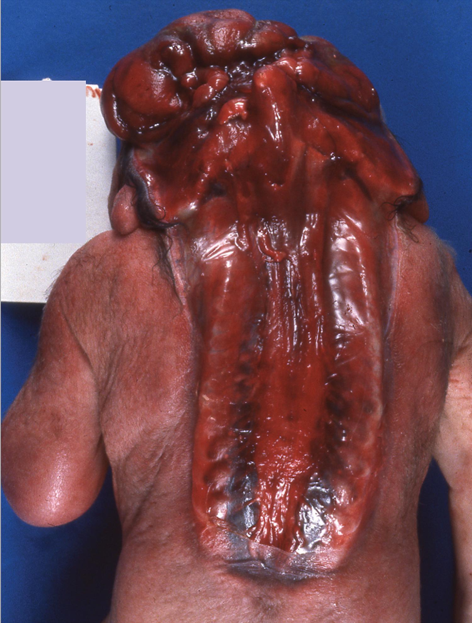 FIGURE 4.4, Complete cerebrospinal rachischisis: dorsal aspect of the spine and cranium demonstrating complete failure of neural tube closure. The cranial vault is absent, replaced by area cerebrovasculosa, and the pedicles of the vertebrae are open.