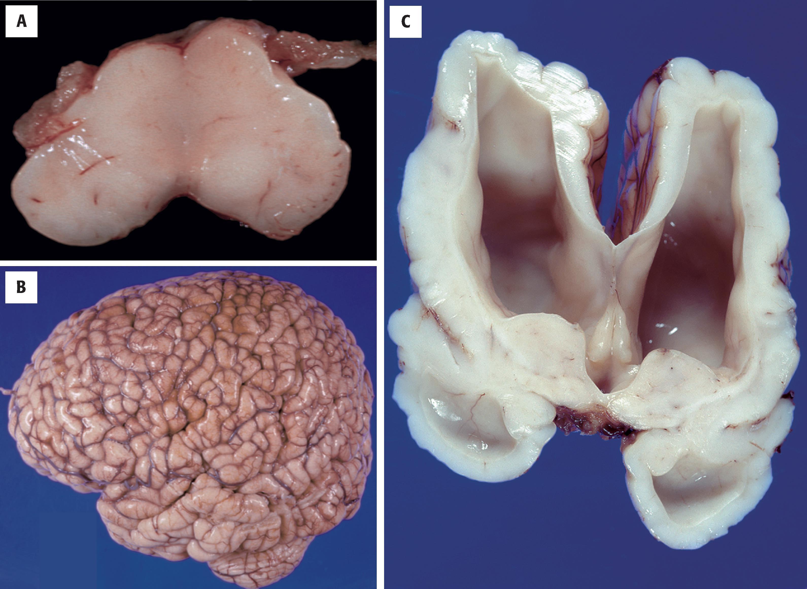 FIGURE 4.41, X-linked aqueductal stenosis. ( A ) Axial section of the midbrain showing absence of the aqueduct. Aqueductal diameter less than 0.5 mm 2 in a child of any age is considered abnormal. ( B ) left lateral view of the brain in this patient demonstrating “pseudopolymicrogyria,” or the appearance of complex gyri resulting from the marked ventricular expansion during cortical development. ( C ) A coronal section through the hemispheres at the level of the temporal poles demonstrates the hydrocephalus.